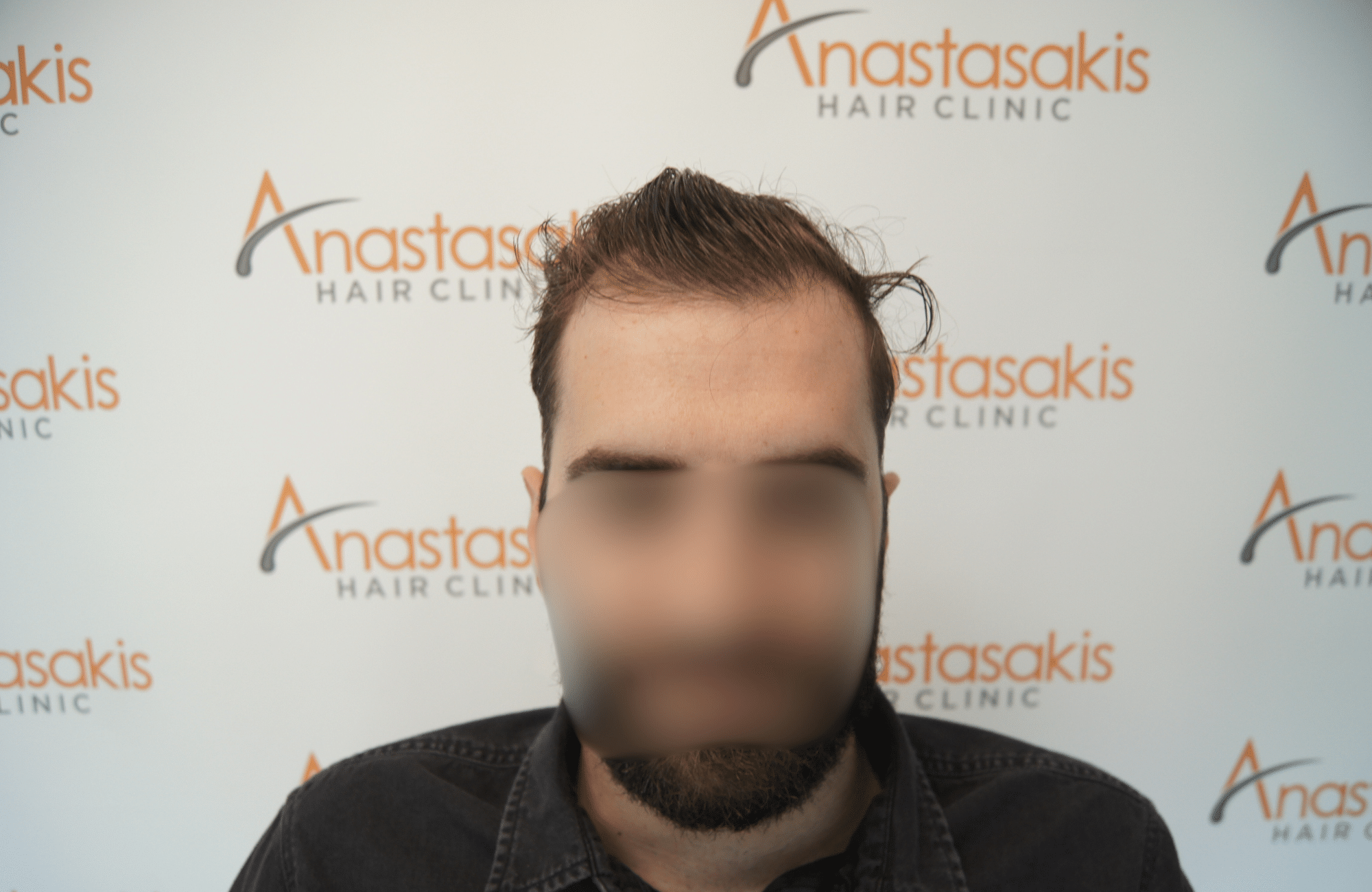 hair transplant result