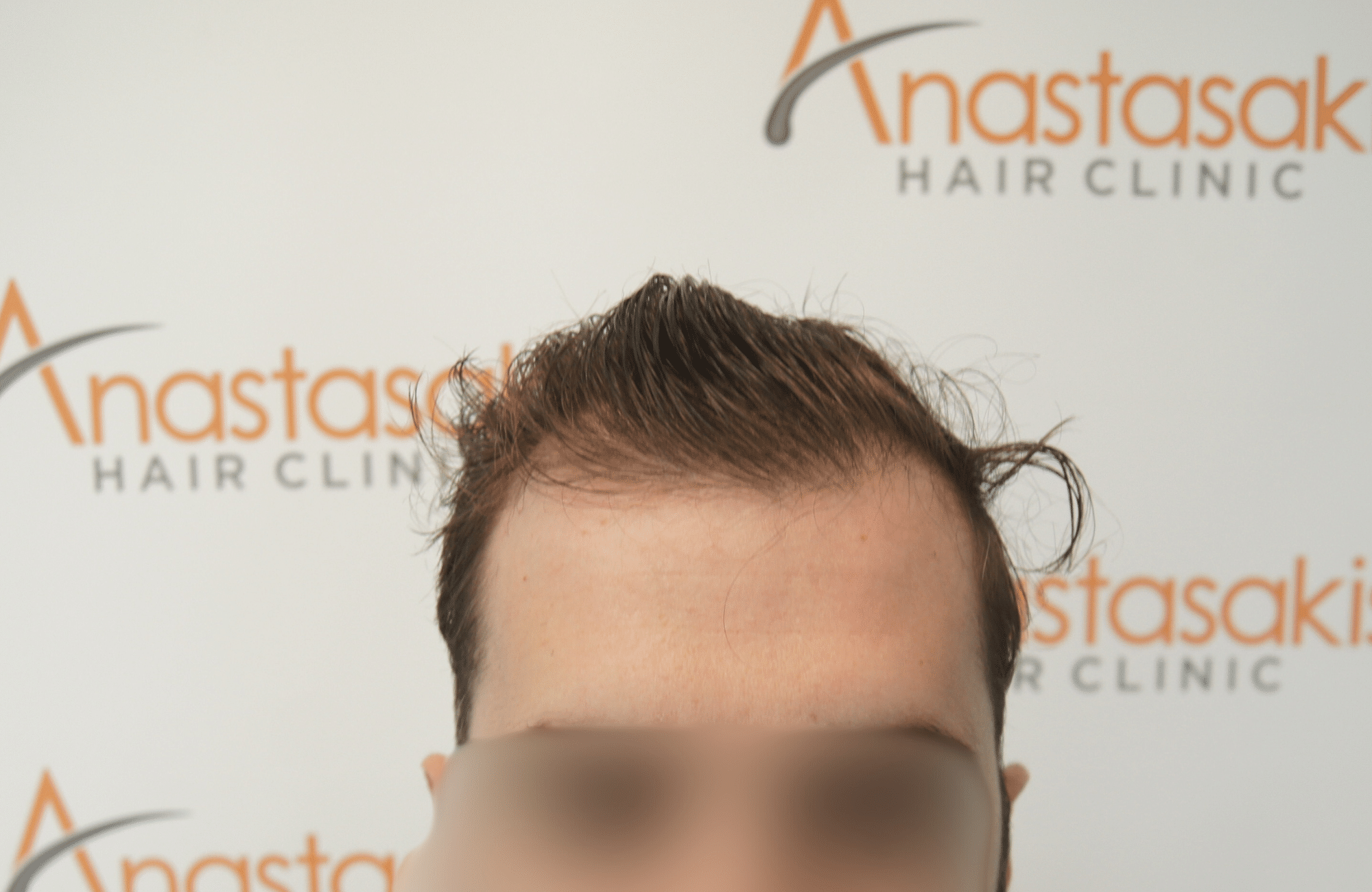 hair transplant result