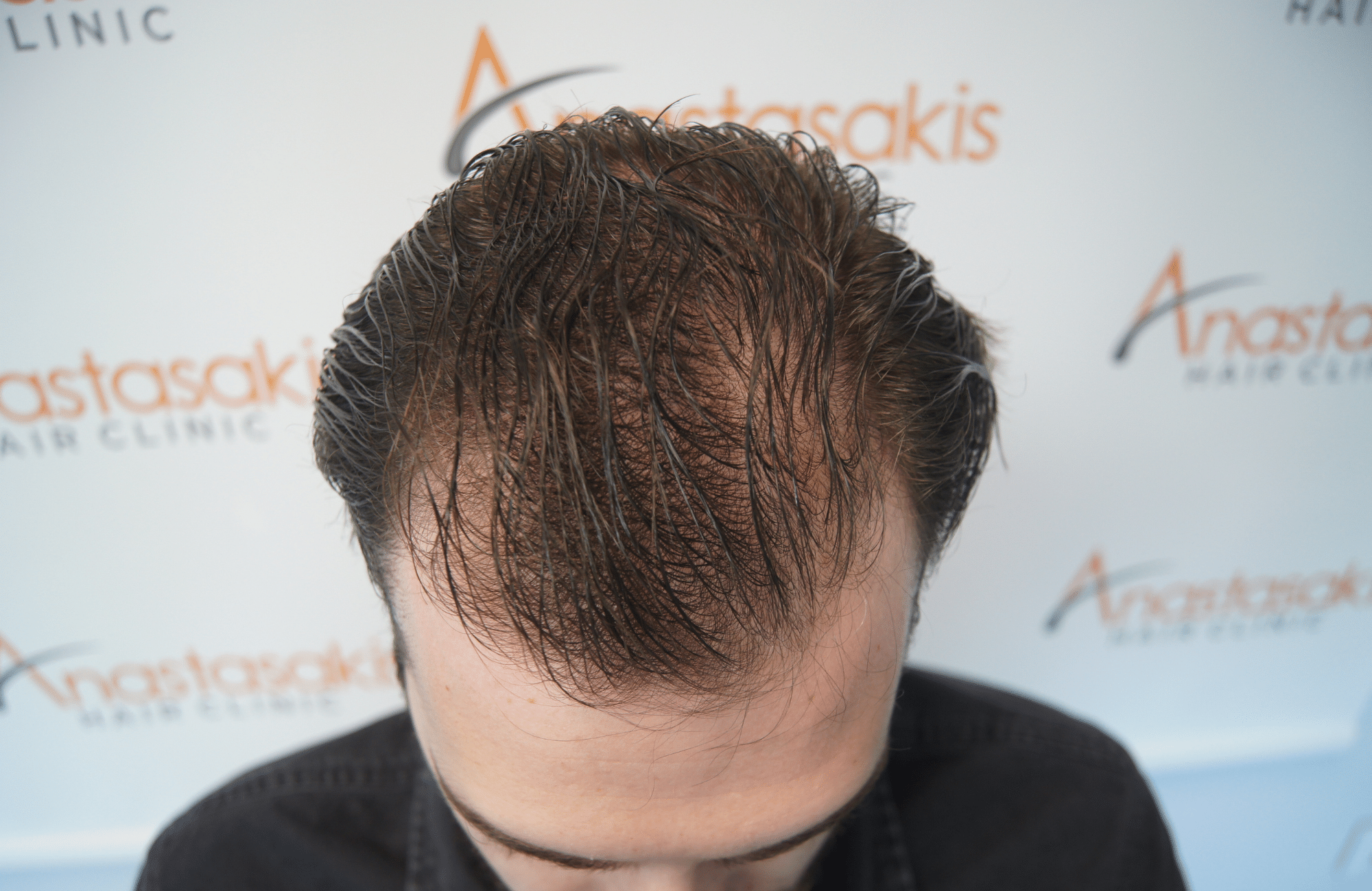 hair transplant result