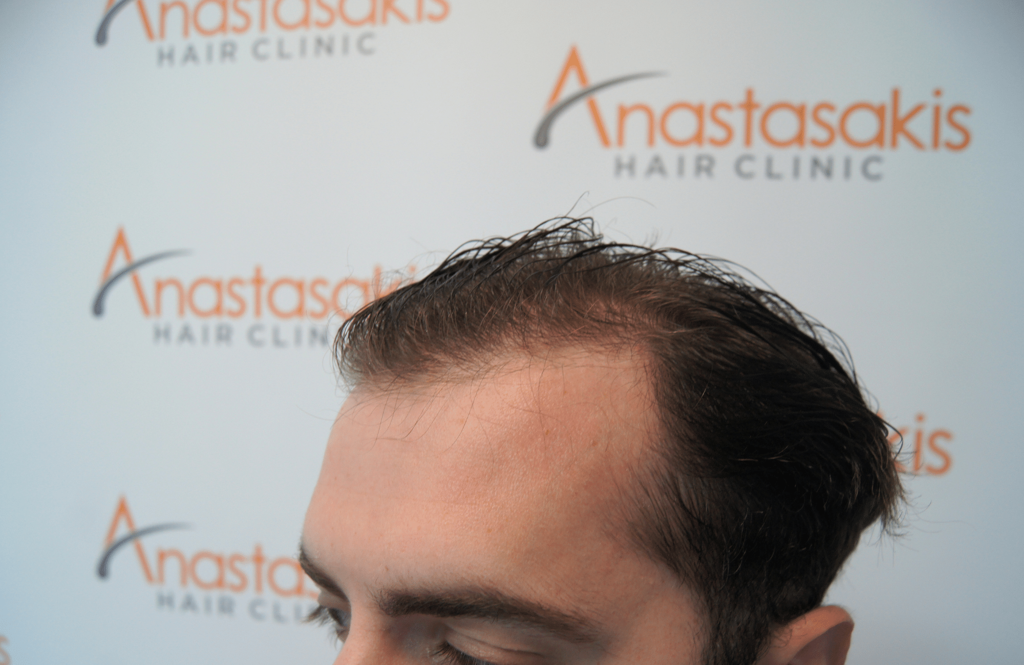 hair transplant result