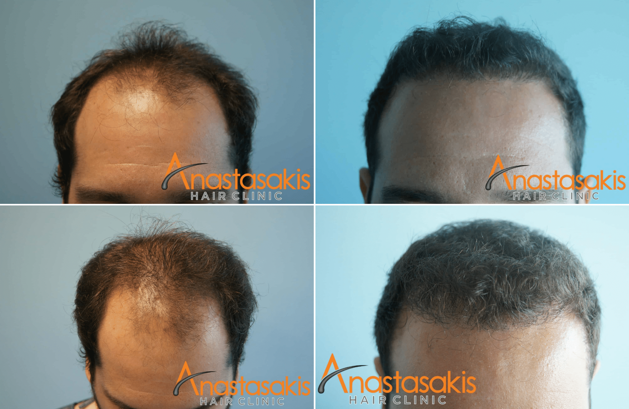 https://www.anastasakishairclinic.gr/portfolio/result-anastasakishairclinic-3000fus_fut/