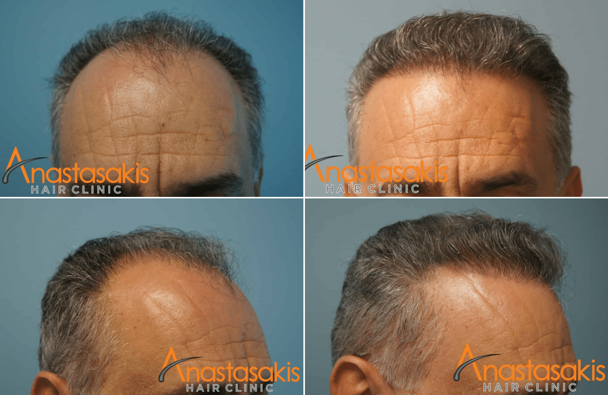 https://www.anastasakishairclinic.gr/portfolio/3000fus-9-anastasakishairclinic/