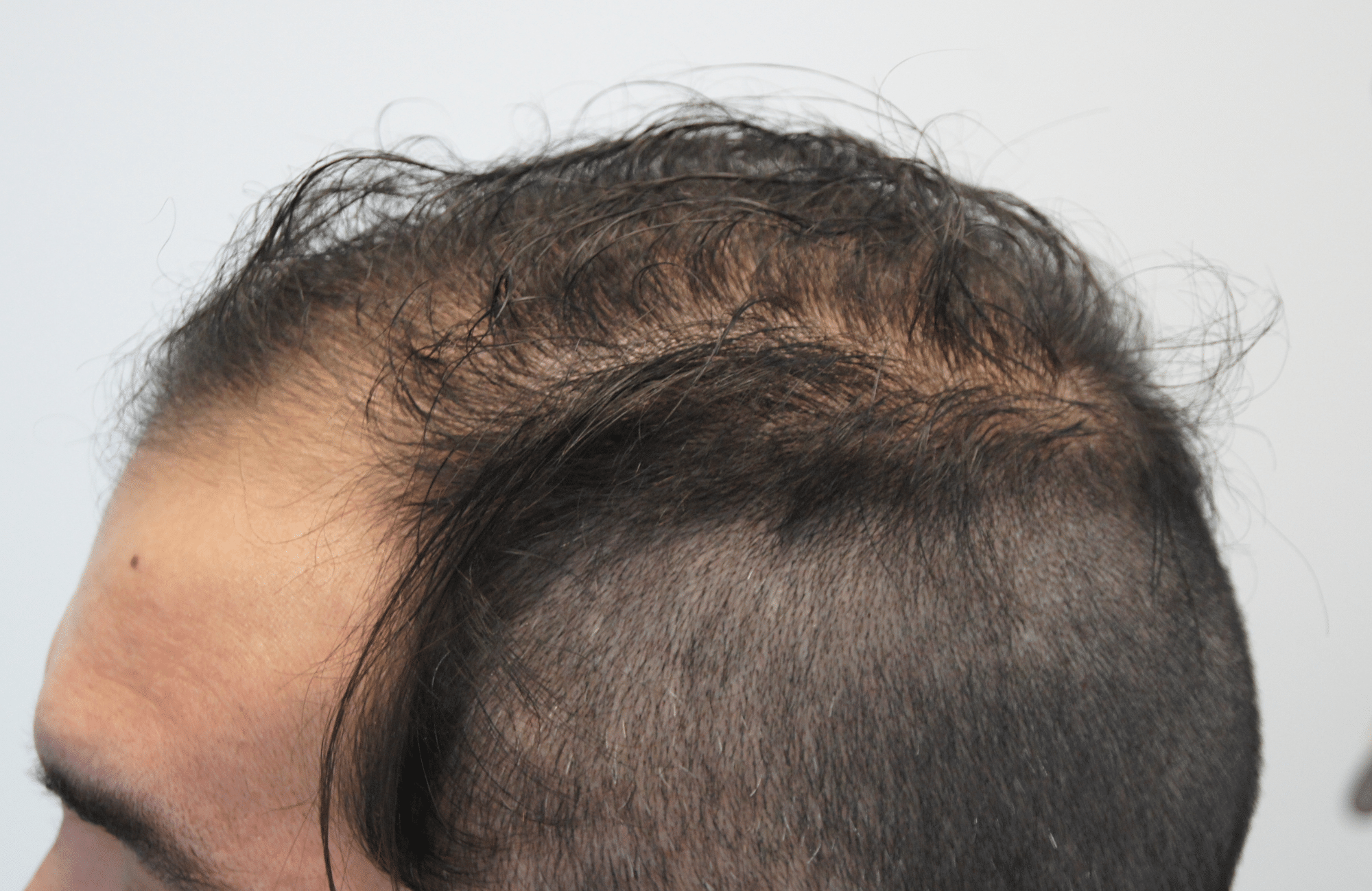 hair transplant result with 2500 follicular units anastasakis hair clinic