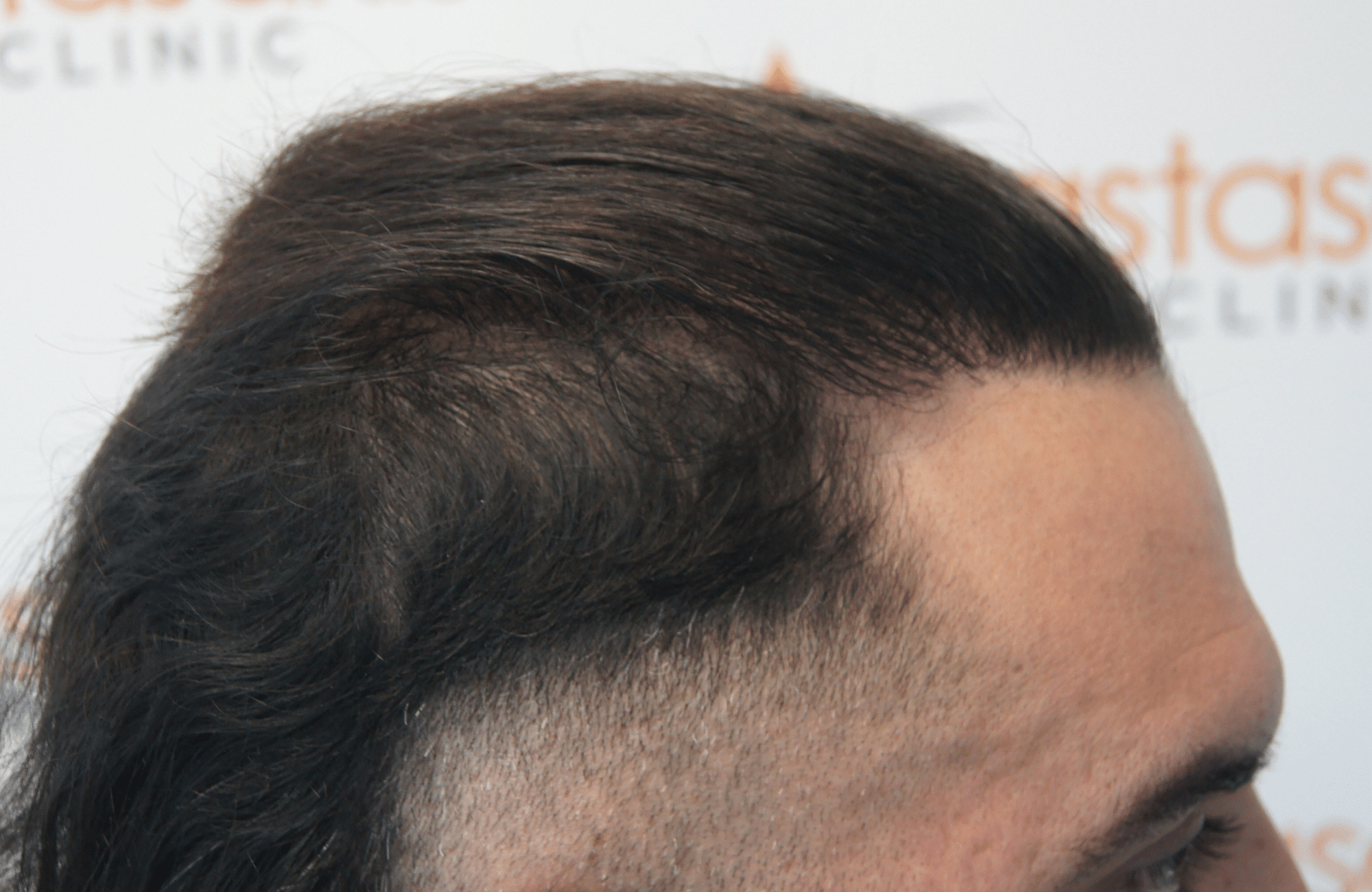 hair transplant result with 2500 follicular units anastasakis hair clinic