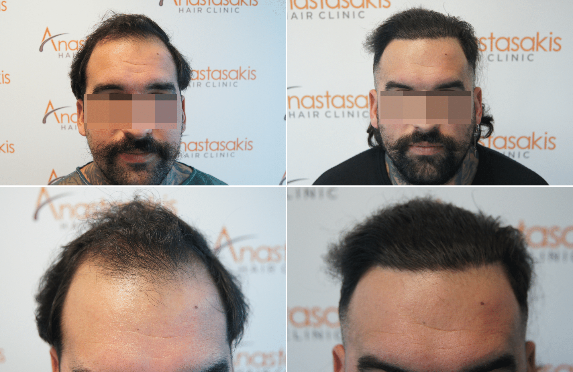 hair transplant result with 2500 follicular units anastasakis hair clinic