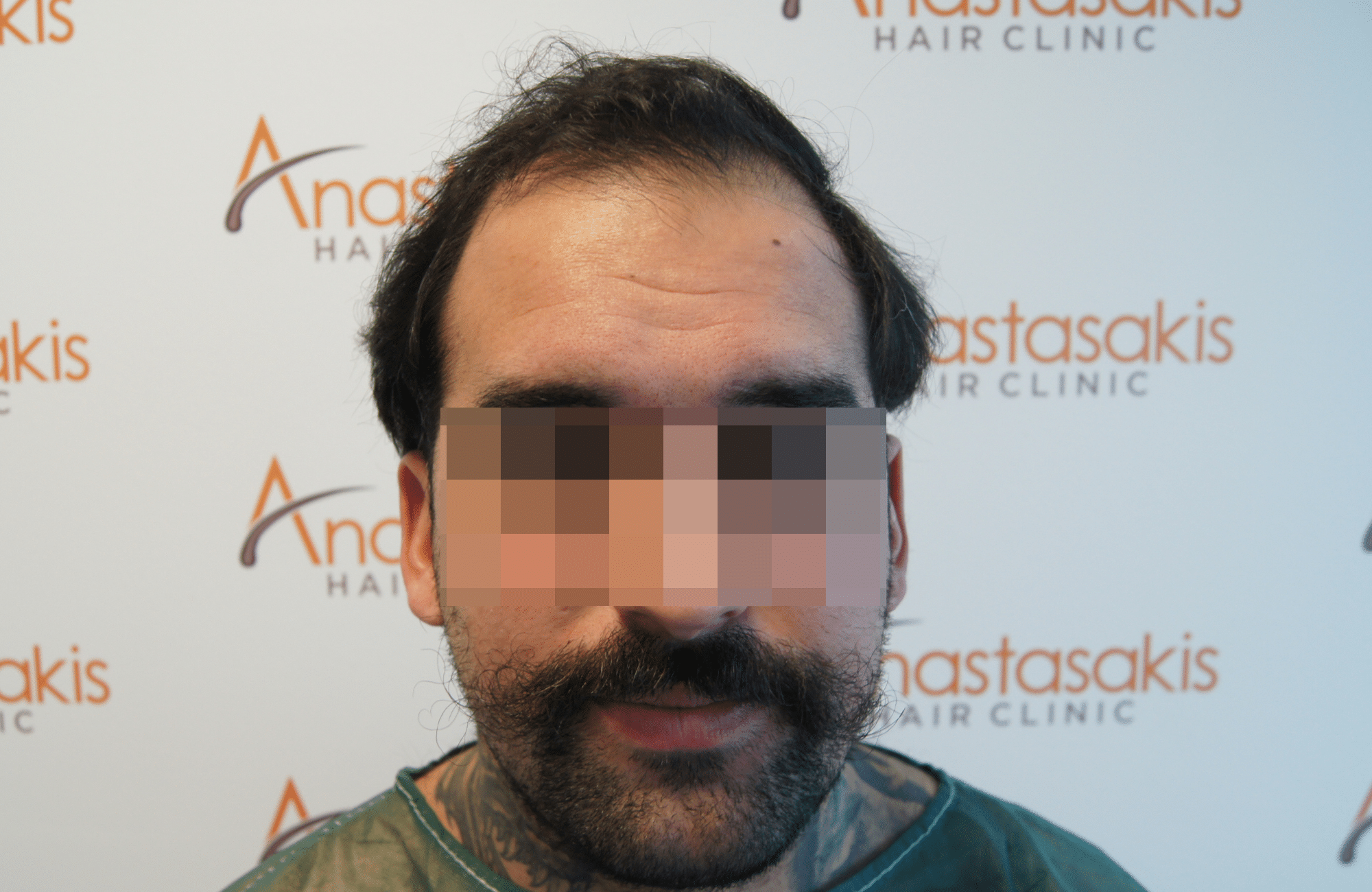 hair transplant result with 2500 follicular units anastasakis hair clinic