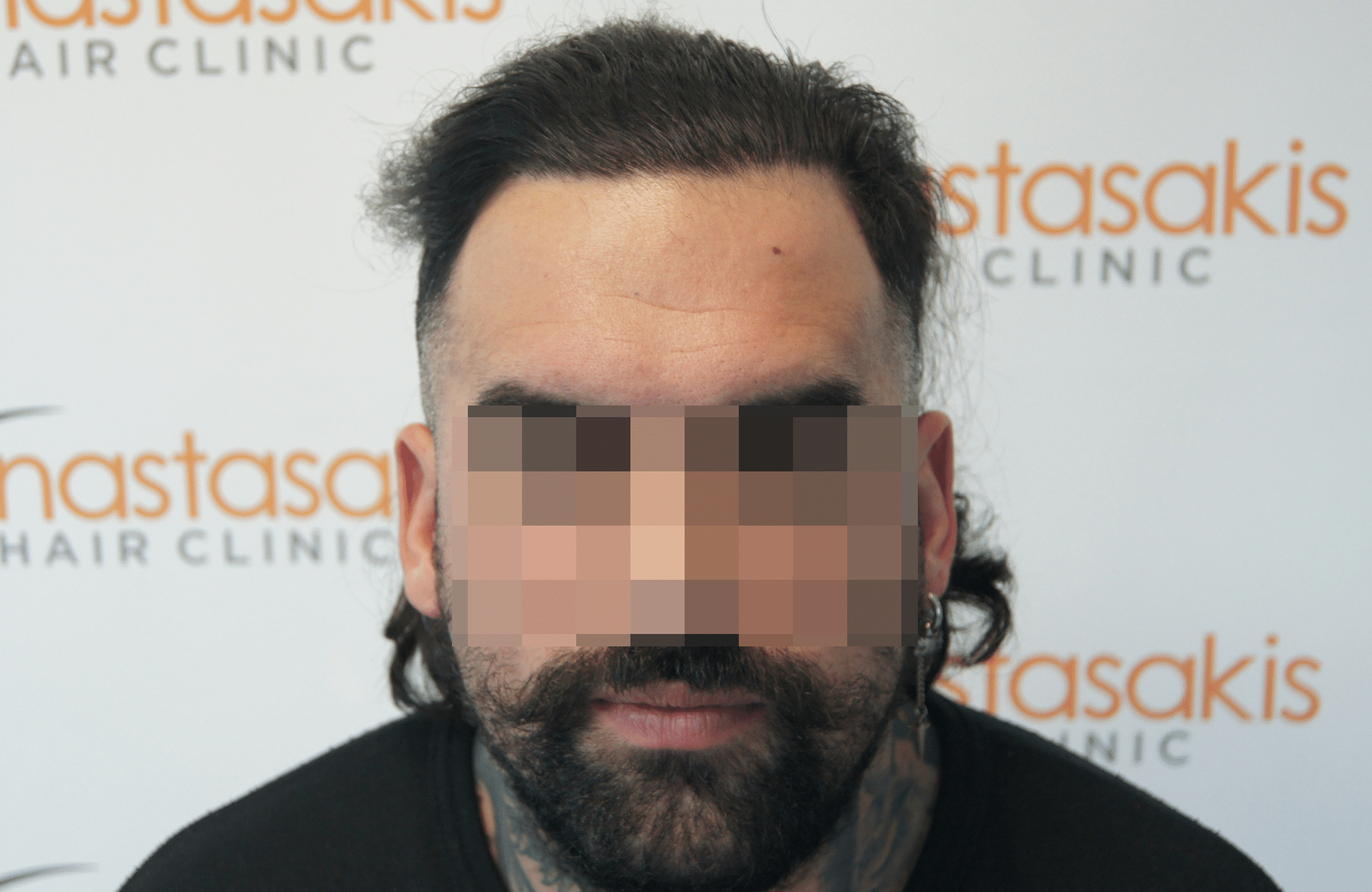 hair transplant result with 2500 follicular units anastasakis hair clinic