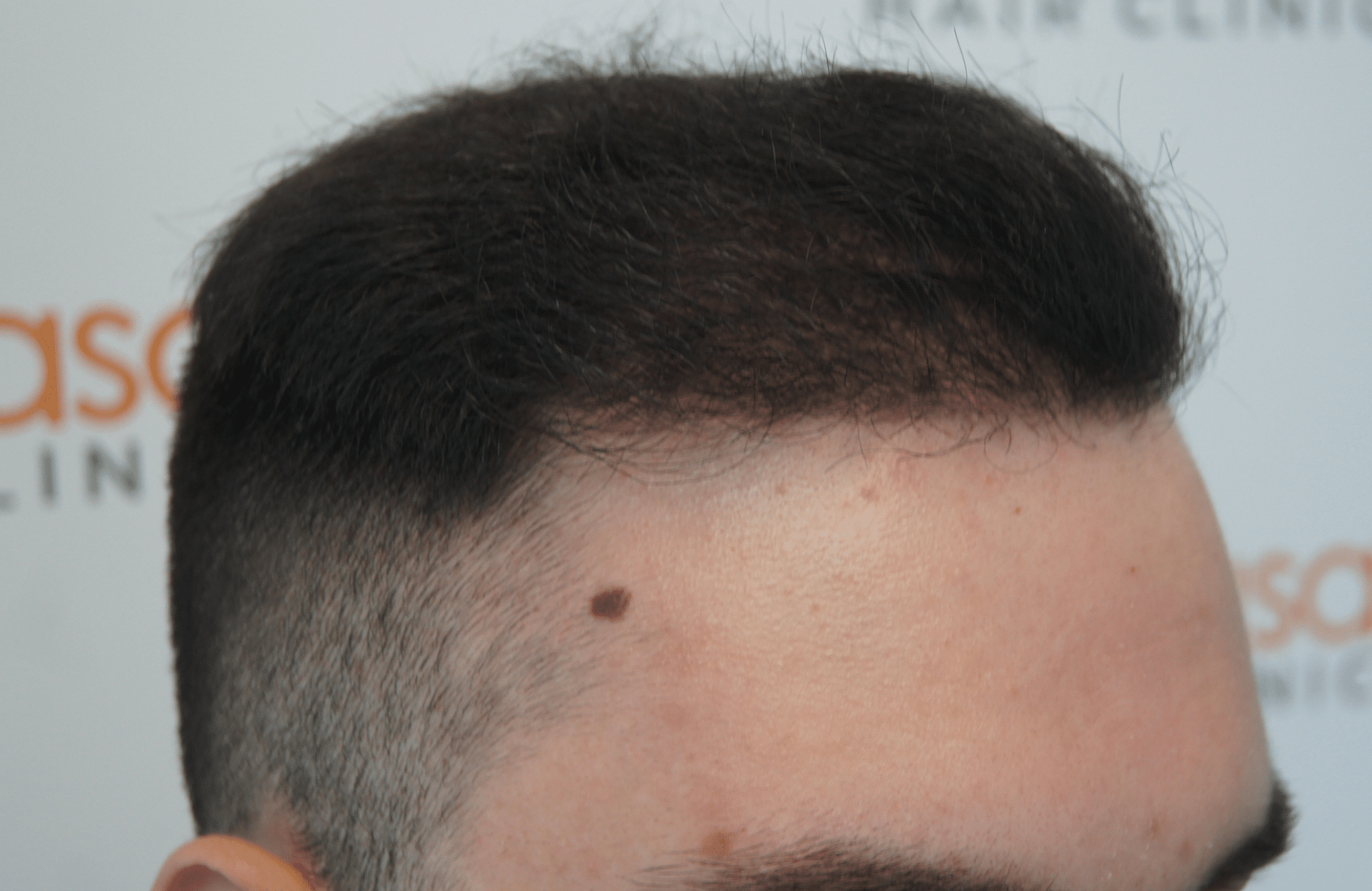 hair transplant result with 2600 follicular units anastasakis hair clinic