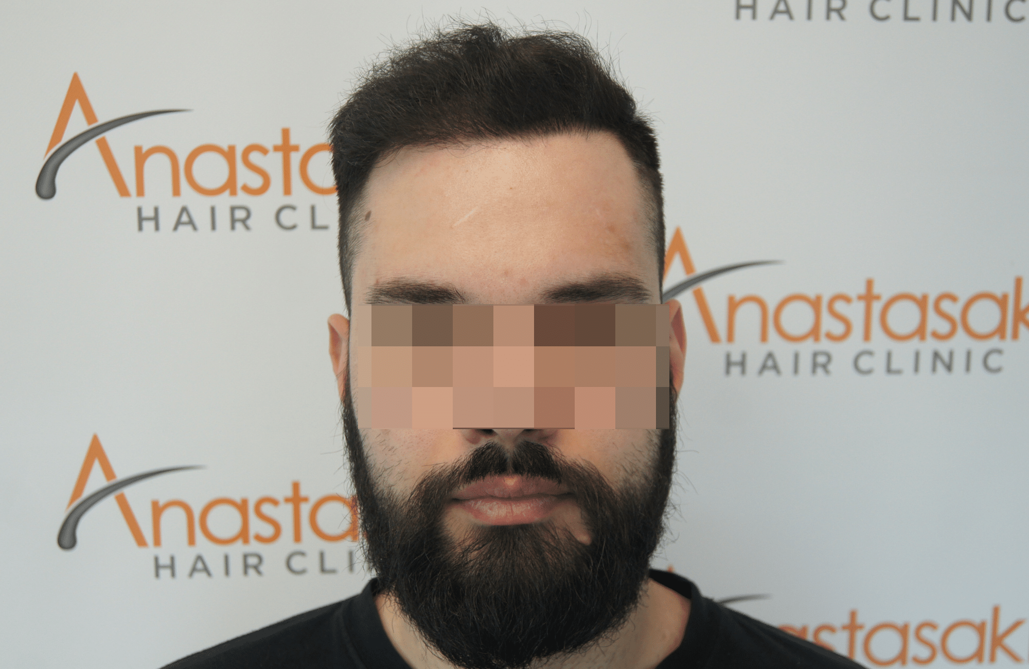 hair transplant result with 2600 follicular units anastasakis hair clinic