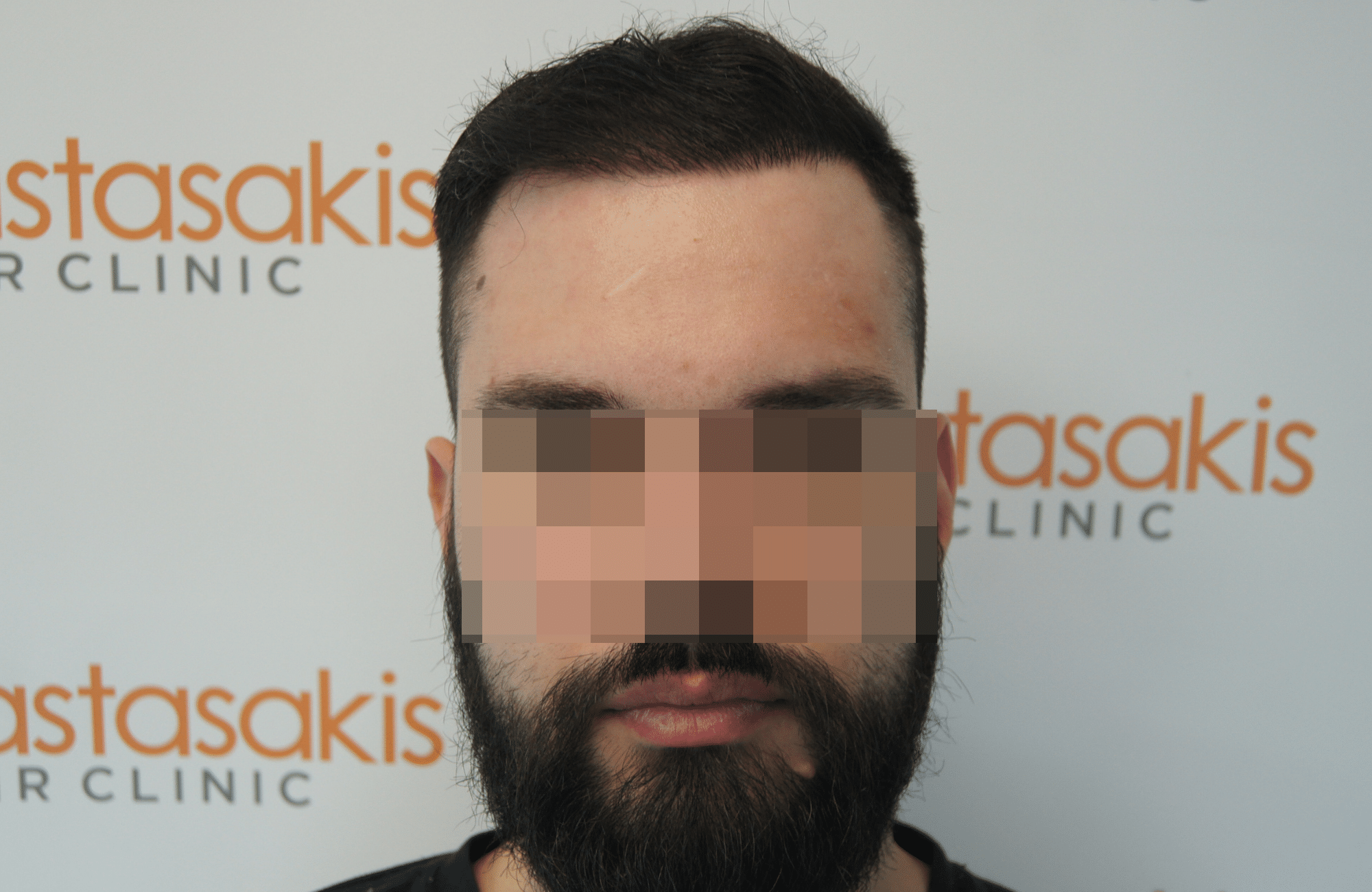 hair transplant result with 2600 follicular units anastasakis hair clinic