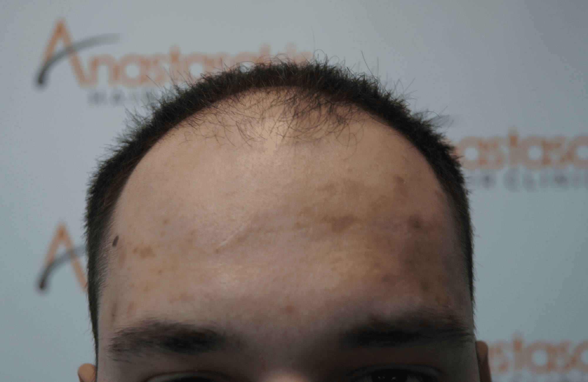 hair transplant result with 2600 follicular units anastasakis hair clinic