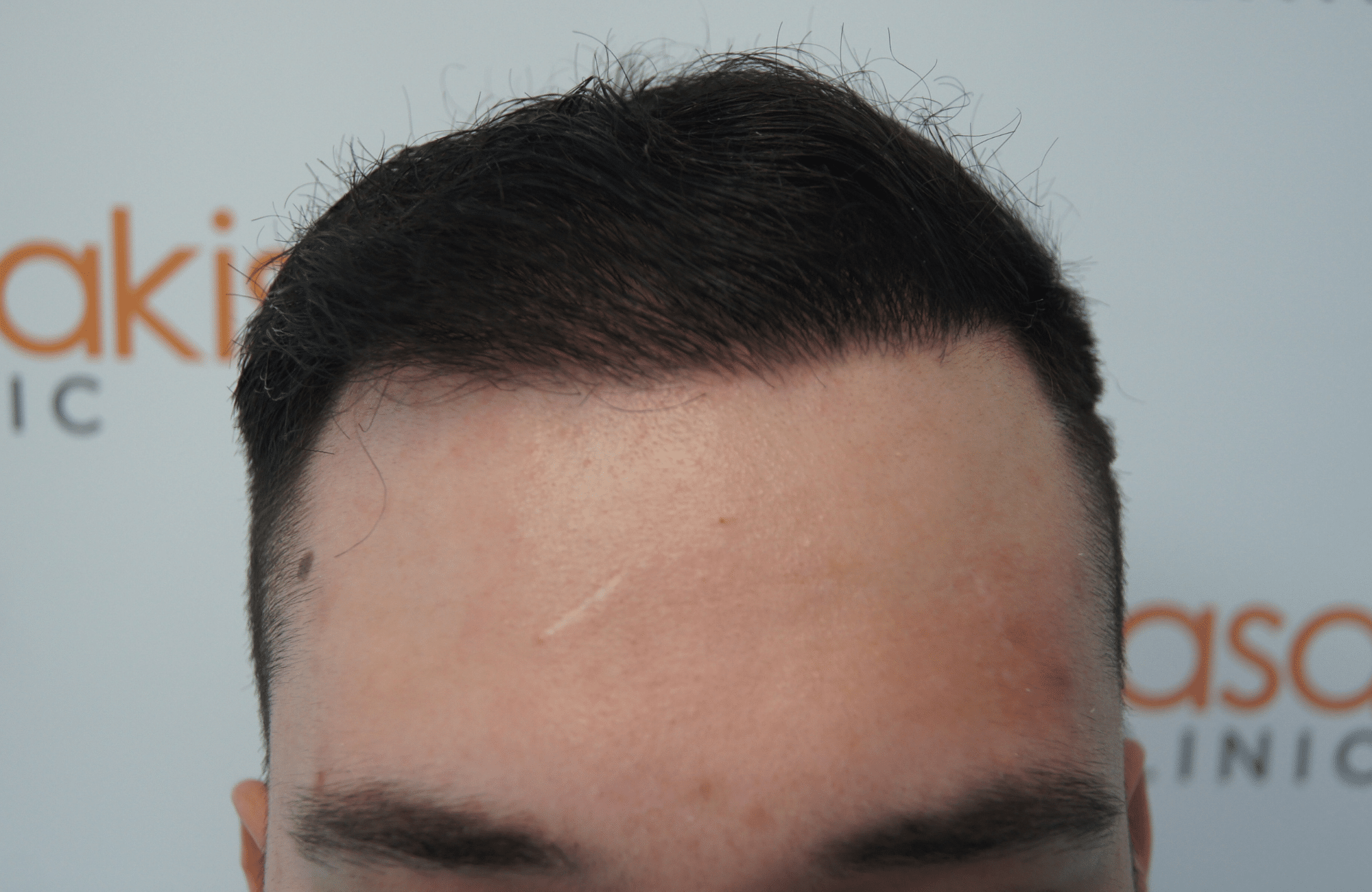 hair transplant result with 2600 follicular units anastasakis hair clinic