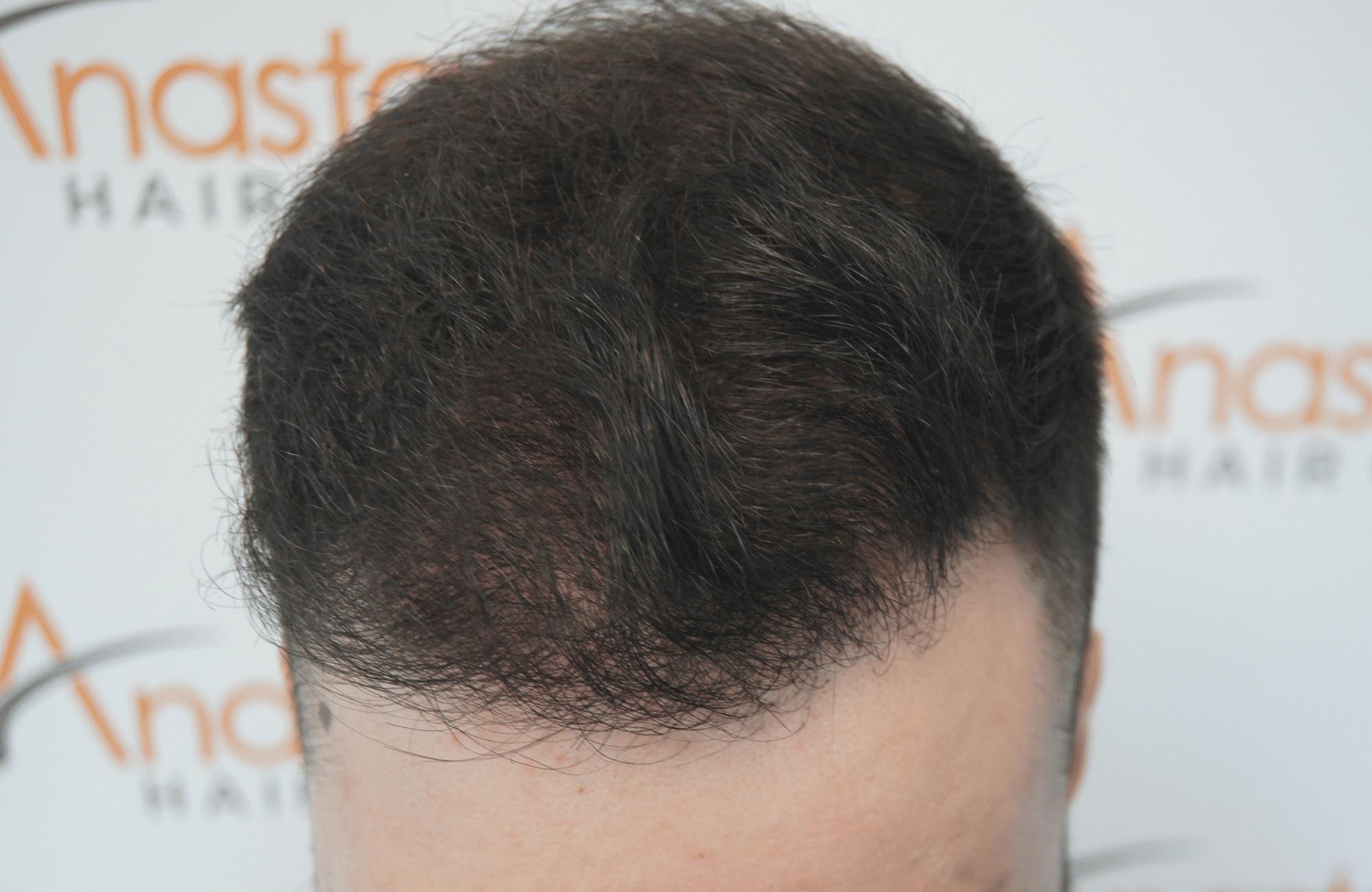 hair transplant result with 2600 follicular units anastasakis hair clinic