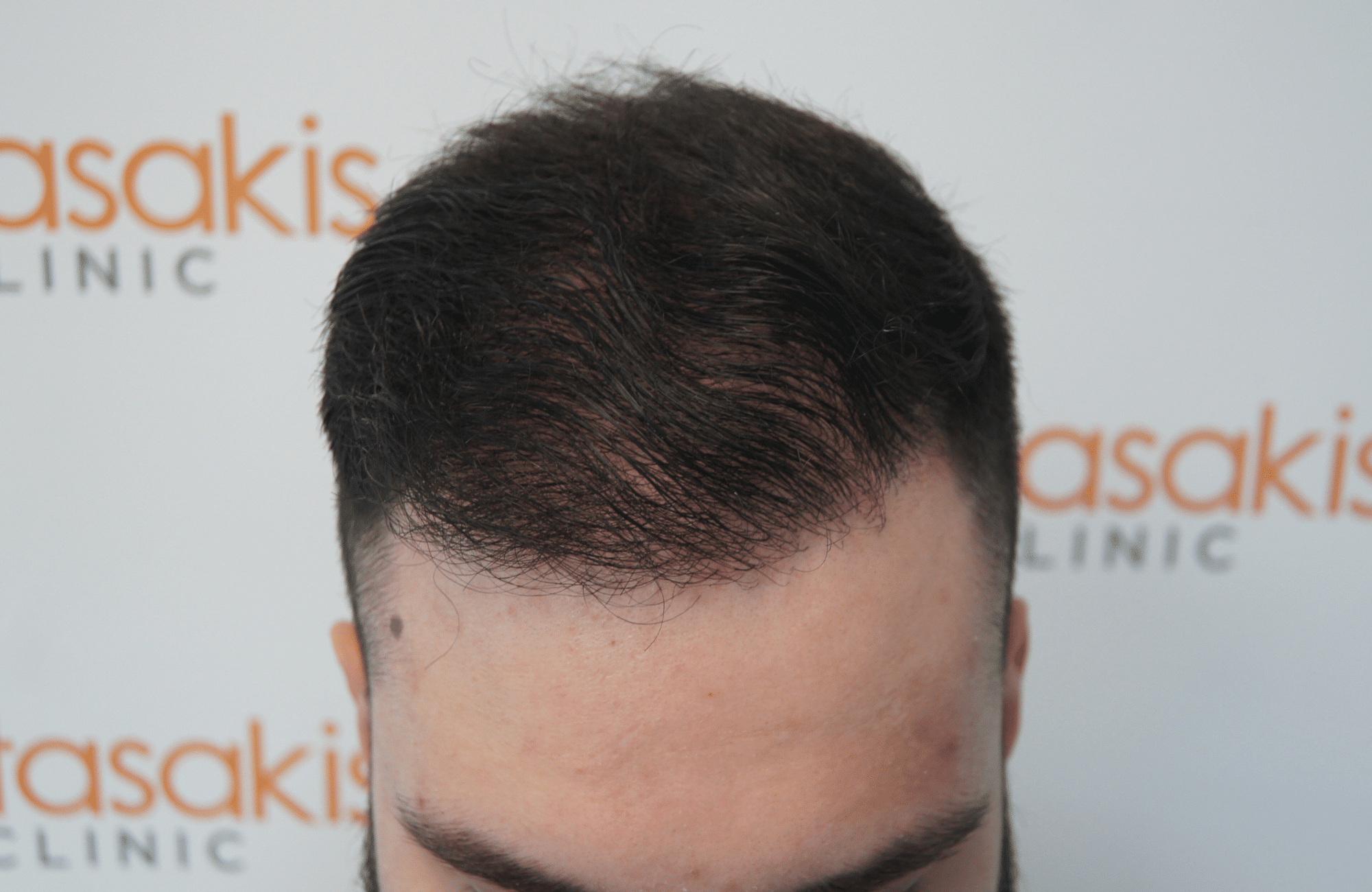 hair transplant result with 2600 follicular units anastasakis hair clinic