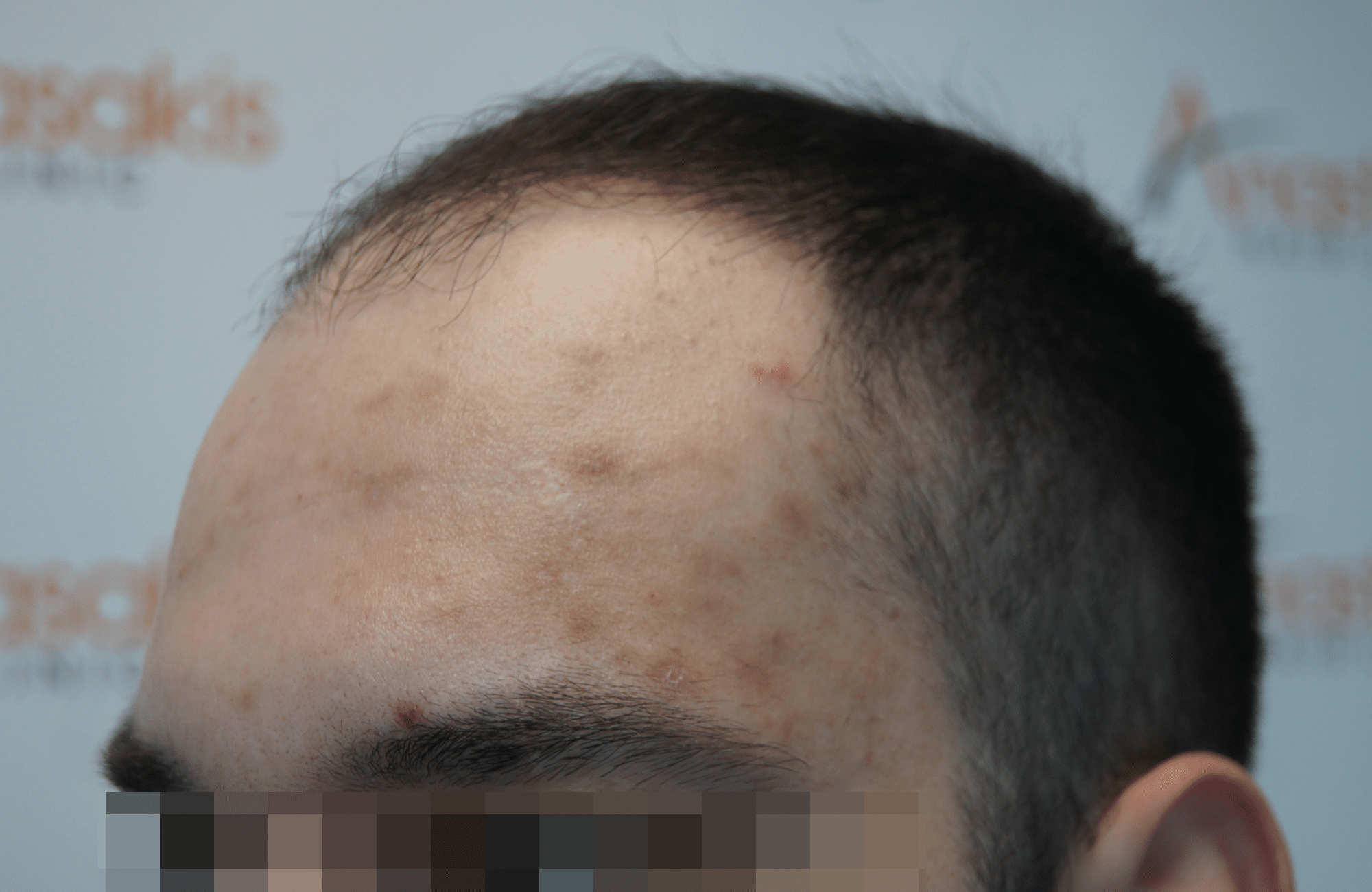 hair transplant result with 2600 follicular units anastasakis hair clinic