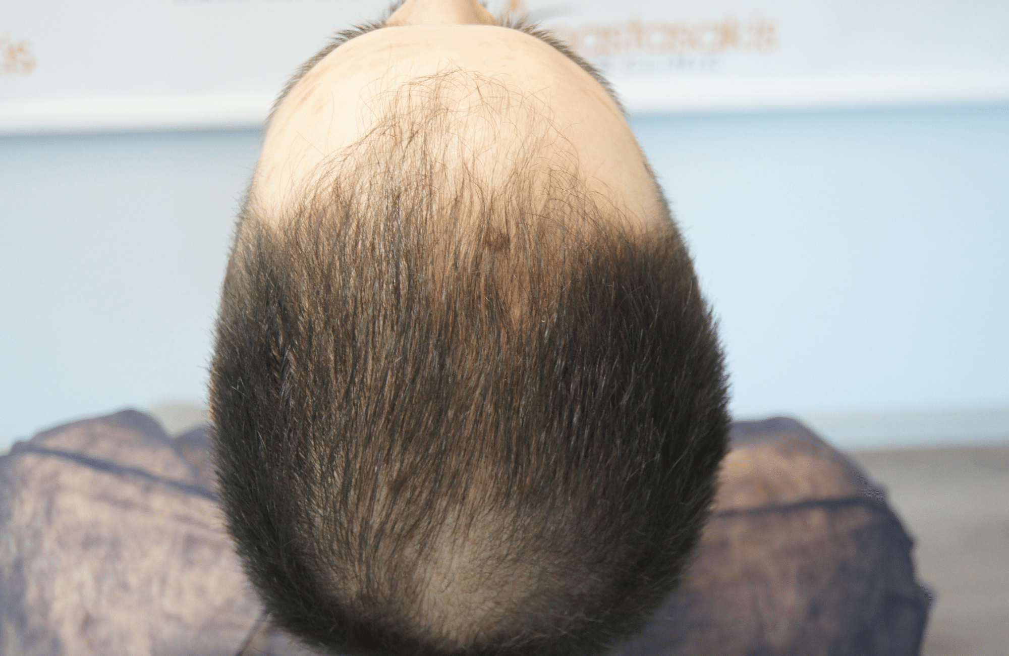 hair transplant result with 2600 follicular units anastasakis hair clinic