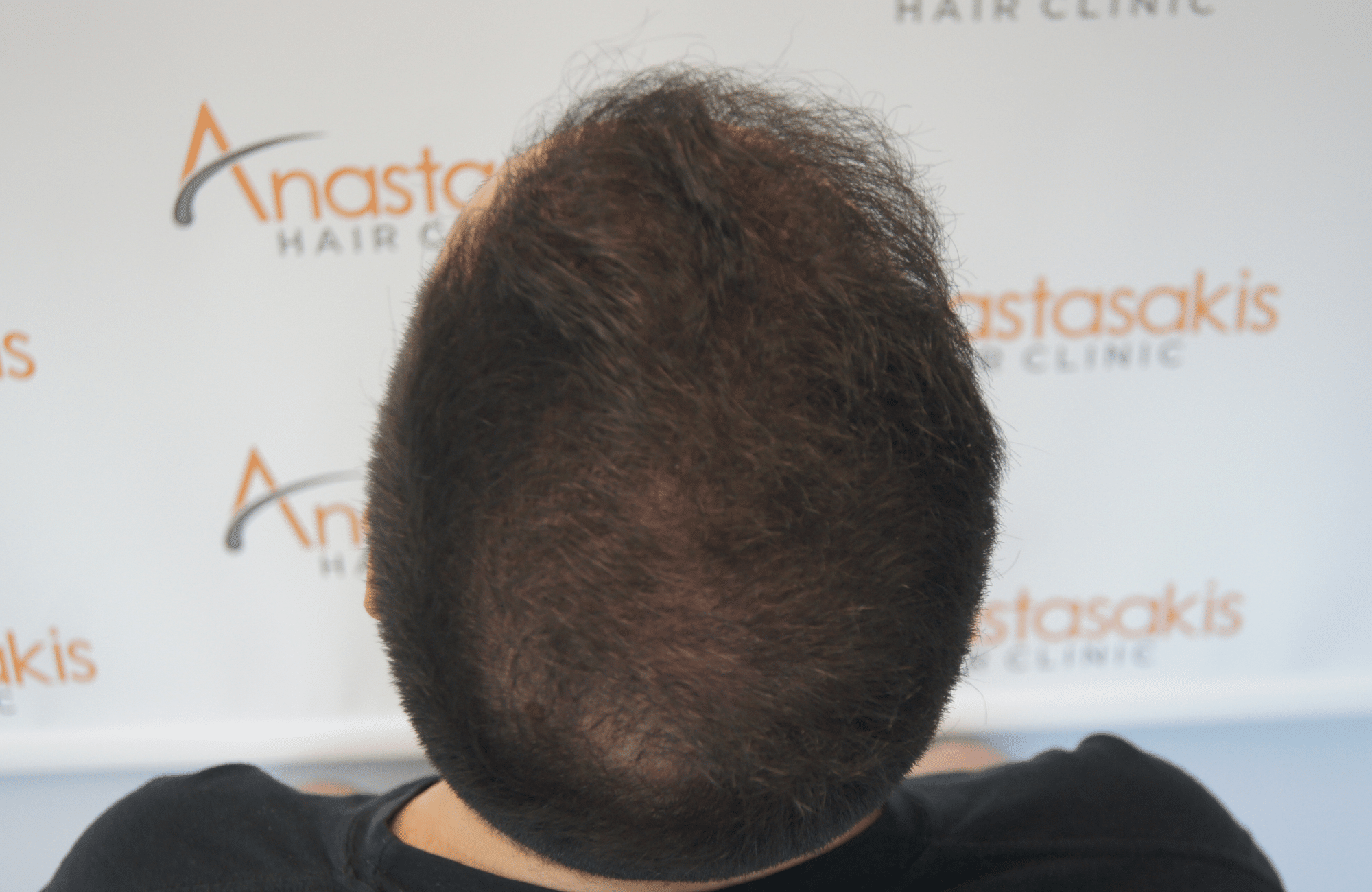 hair transplant result with 2600 follicular units anastasakis hair clinic