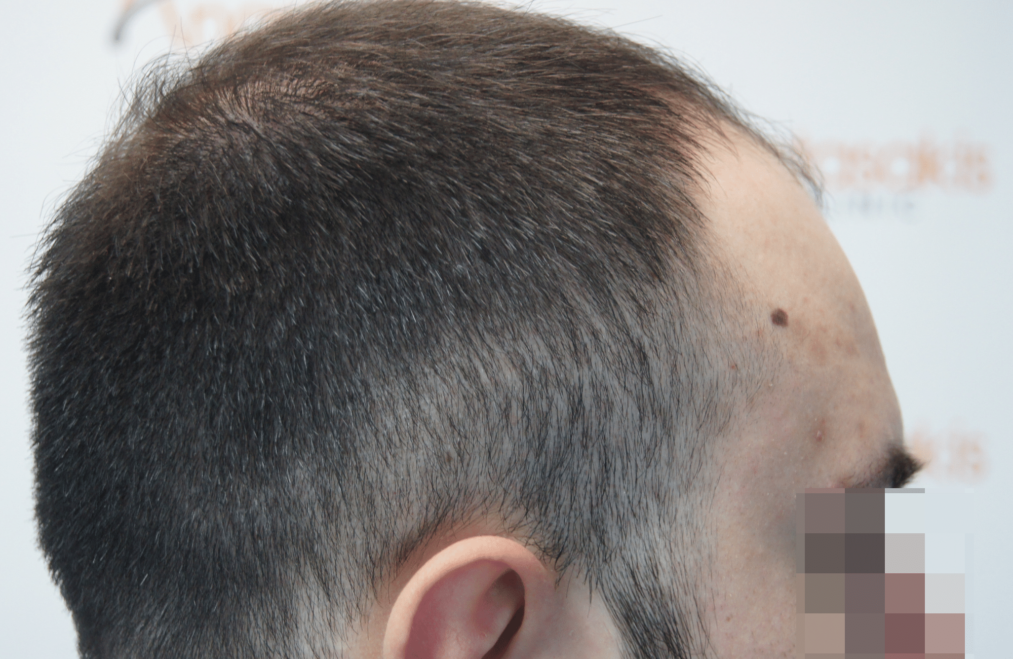 hair transplant result with 2600 follicular units anastasakis hair clinic