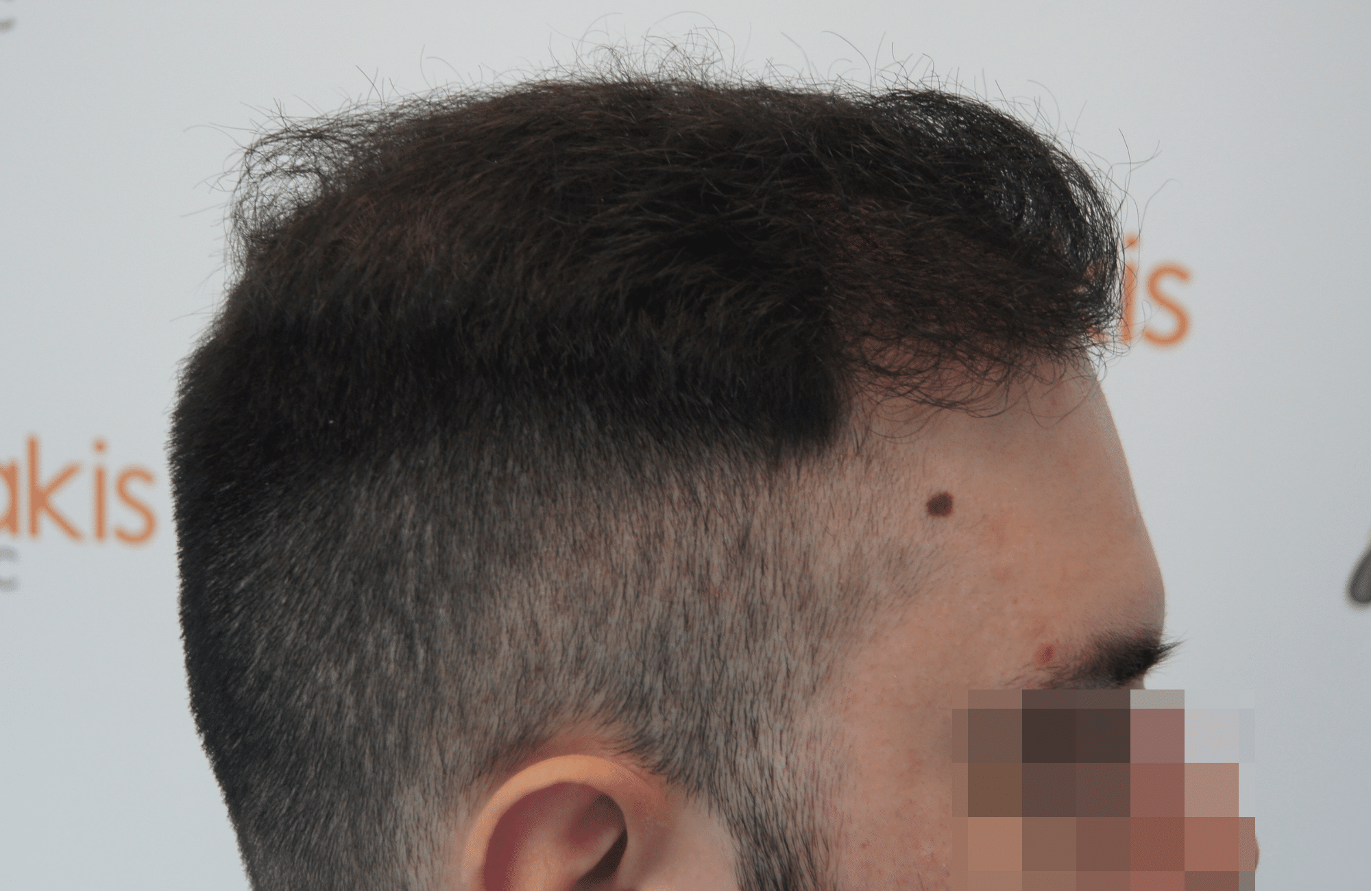 hair transplant result with 2600 follicular units anastasakis hair clinic