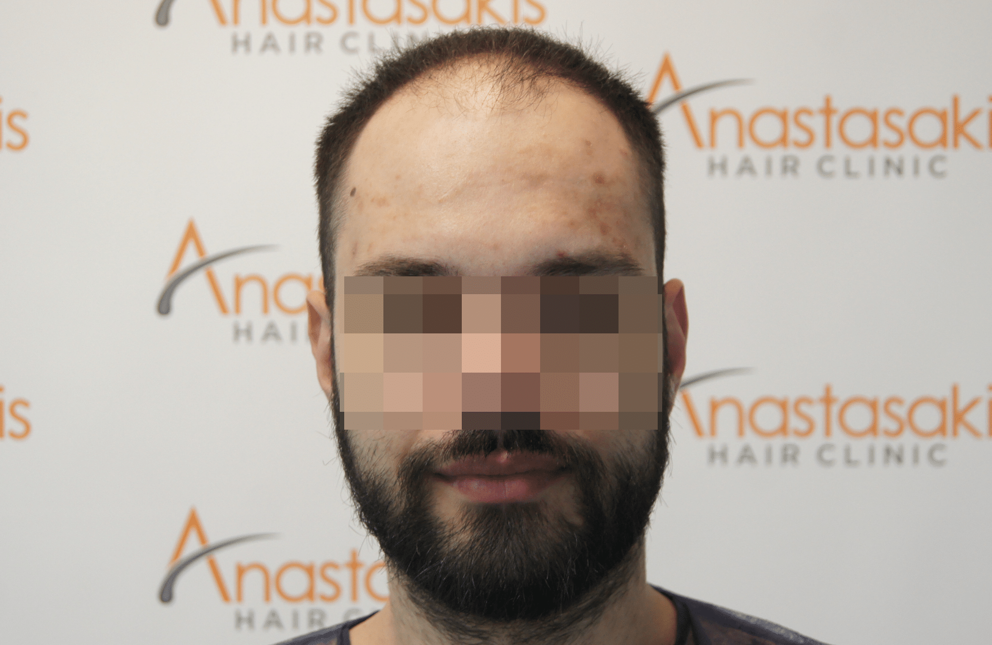 hair transplant result with 2600 follicular units anastasakis hair clinic