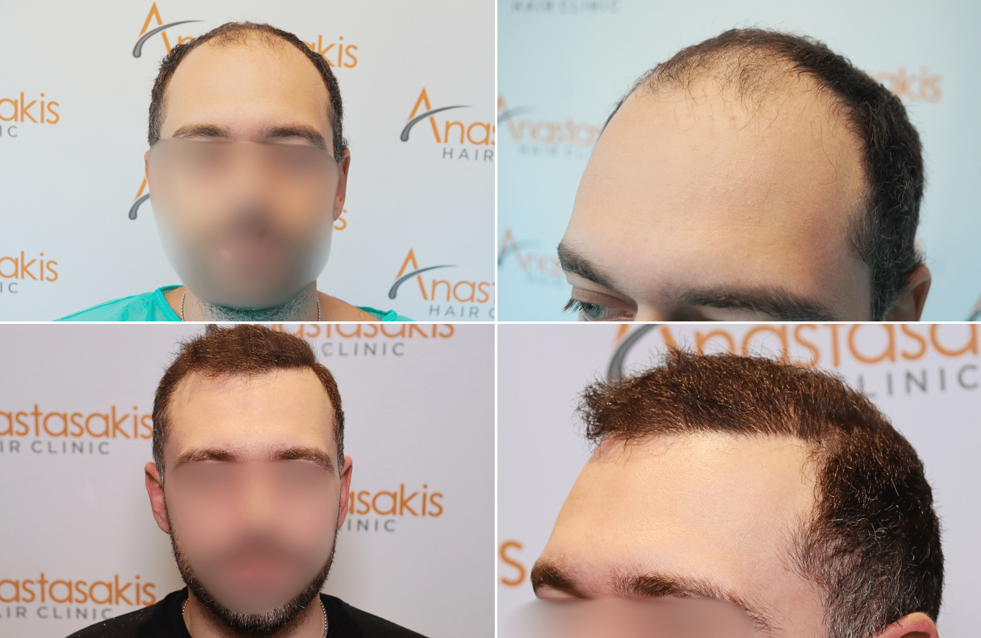 https://www.anastasakishairclinic.gr/portfolio/hair-transplant-result-anastasakis-hair-clinic-600/