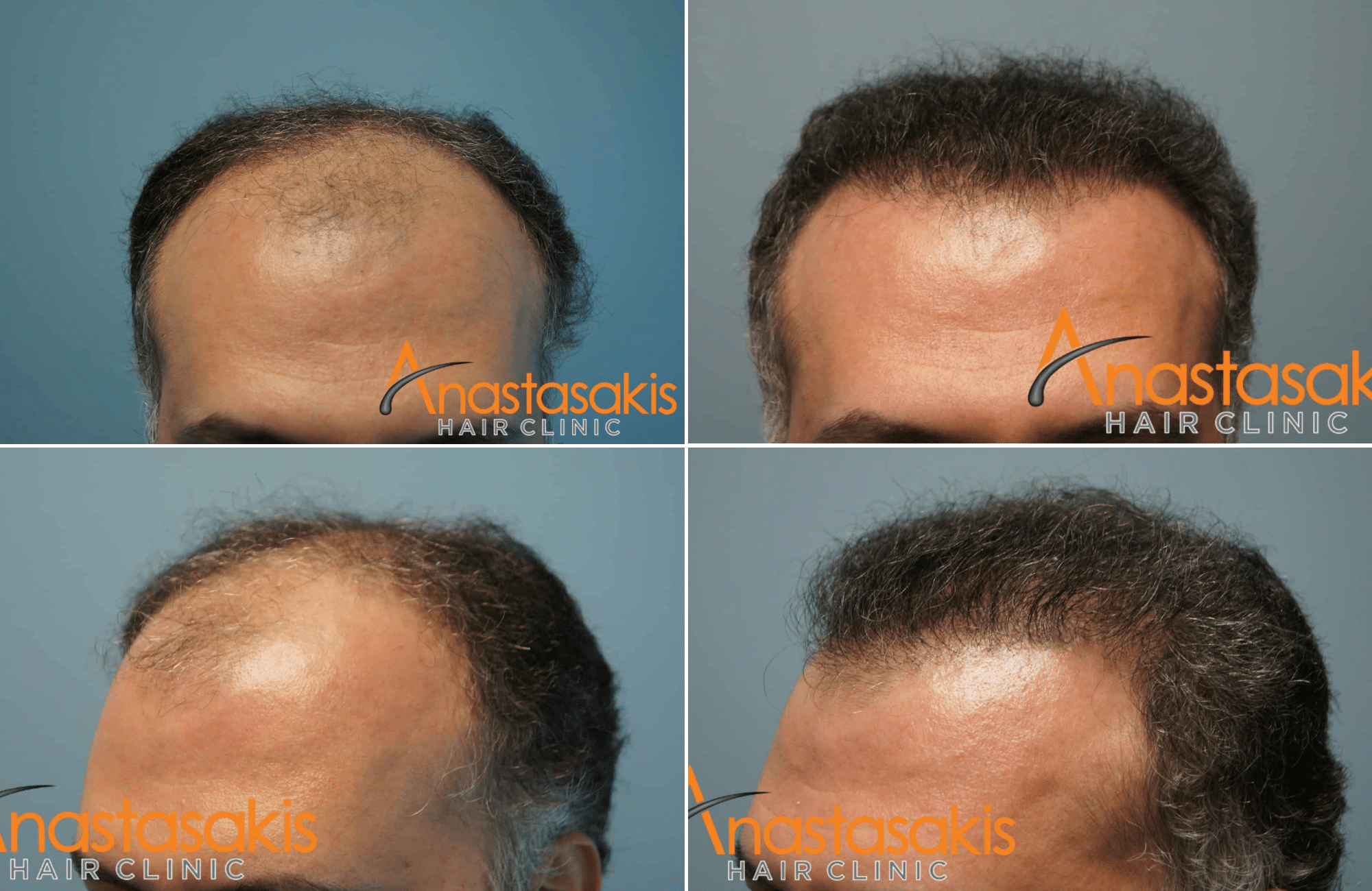 https://www.anastasakishairclinic.gr/portfolio/2800fus-peristatikomm-anastasakis-hair-clinic/