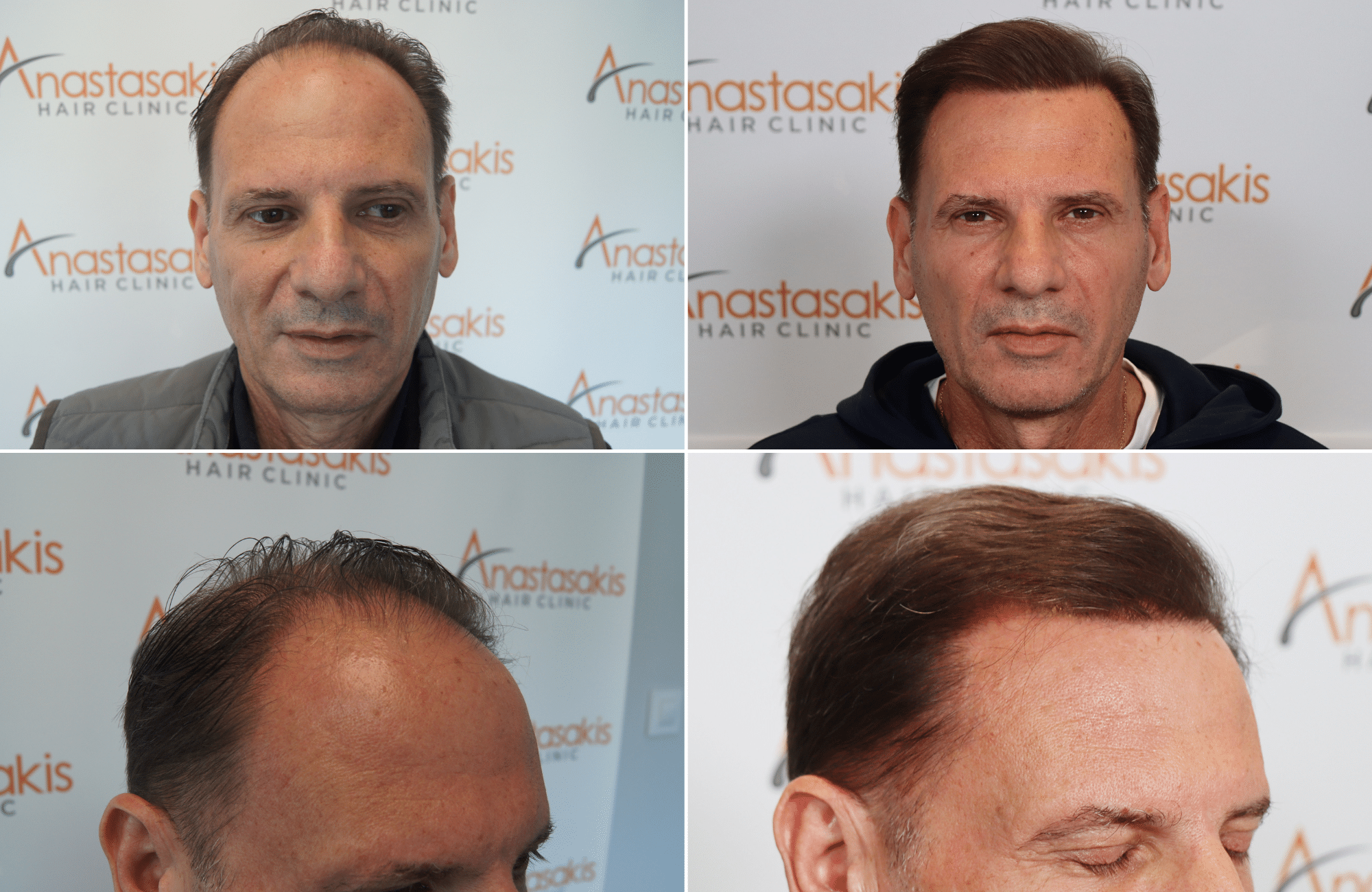 hair transplant result by anastassakis konstantinos