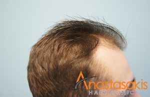 anastasakis-hair-clinic-1300fus-fuemethod-13months later