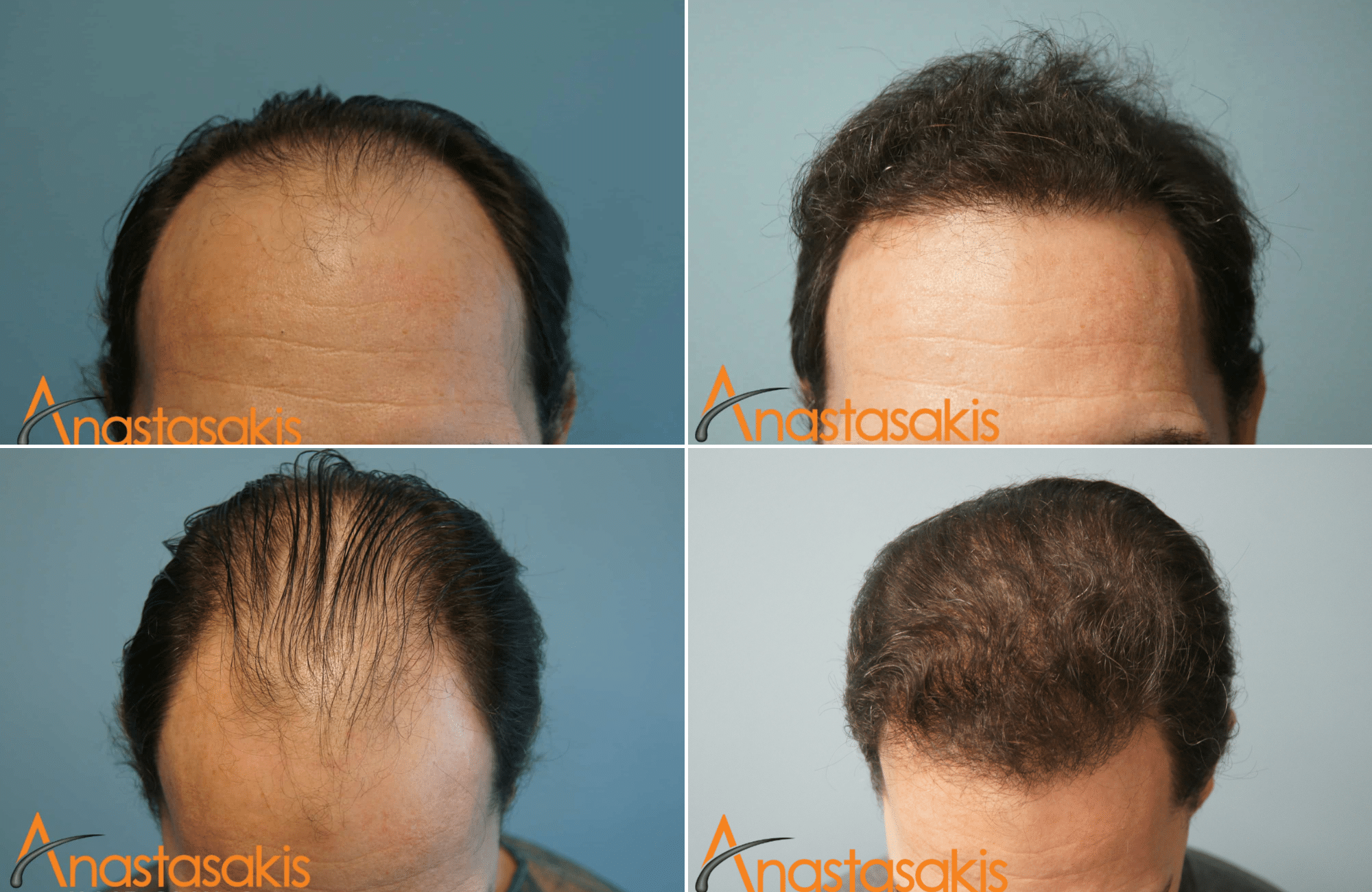 https://www.anastasakishairclinic.gr/portfolio/2530-fus-fullhair-result-anastasakishairclinic/