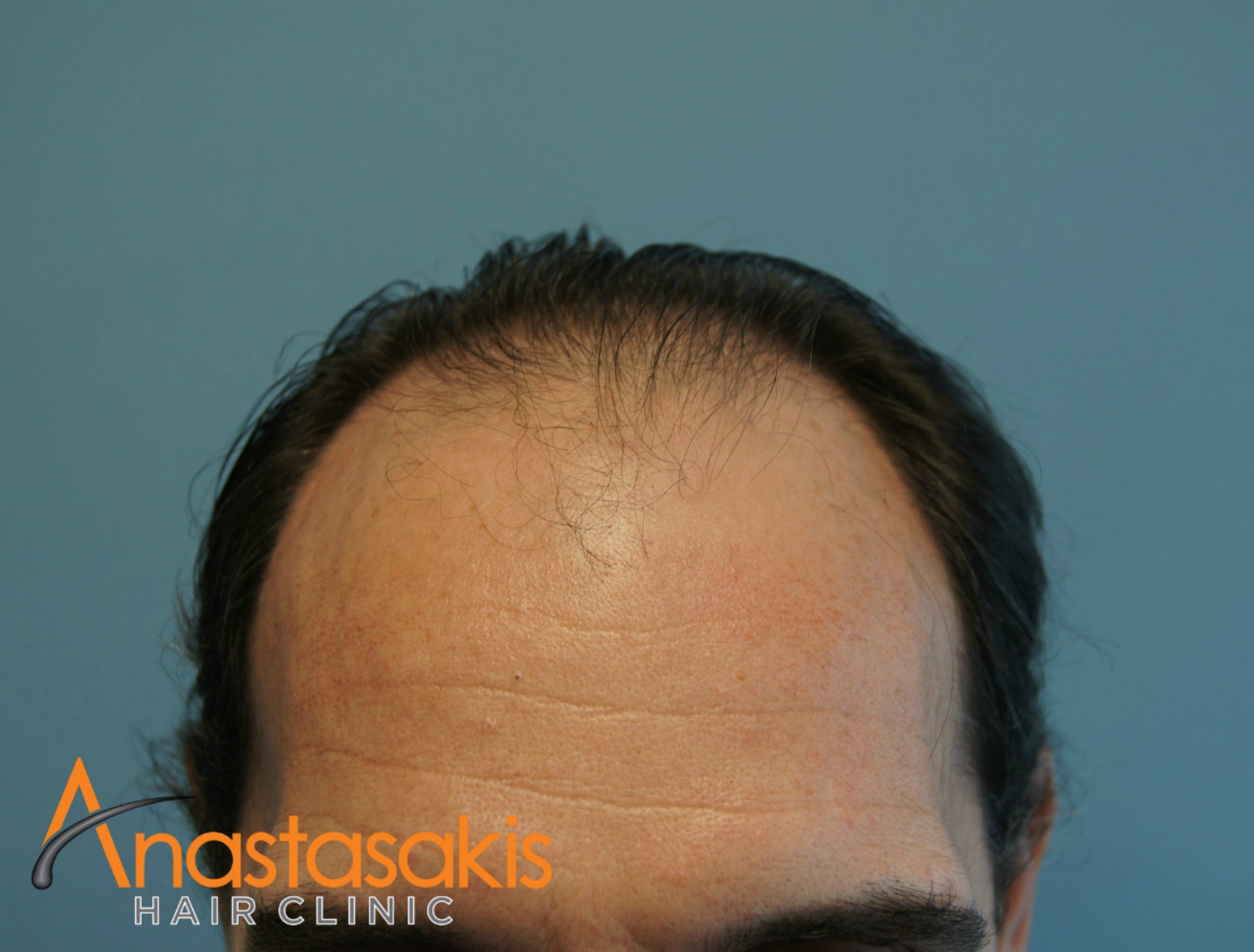 2530-FUS-result-anastasakis-hair-clinic-mar-fut