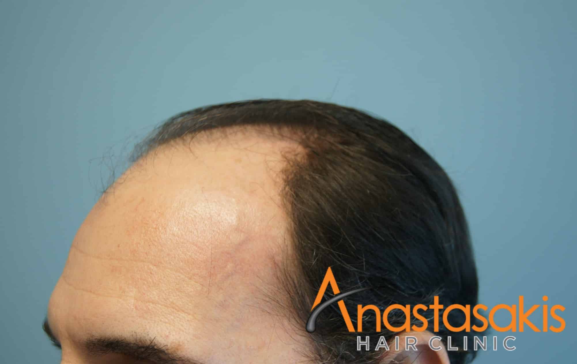 2530-FUS-result-anastasakis-hair-clinic-mar-fut