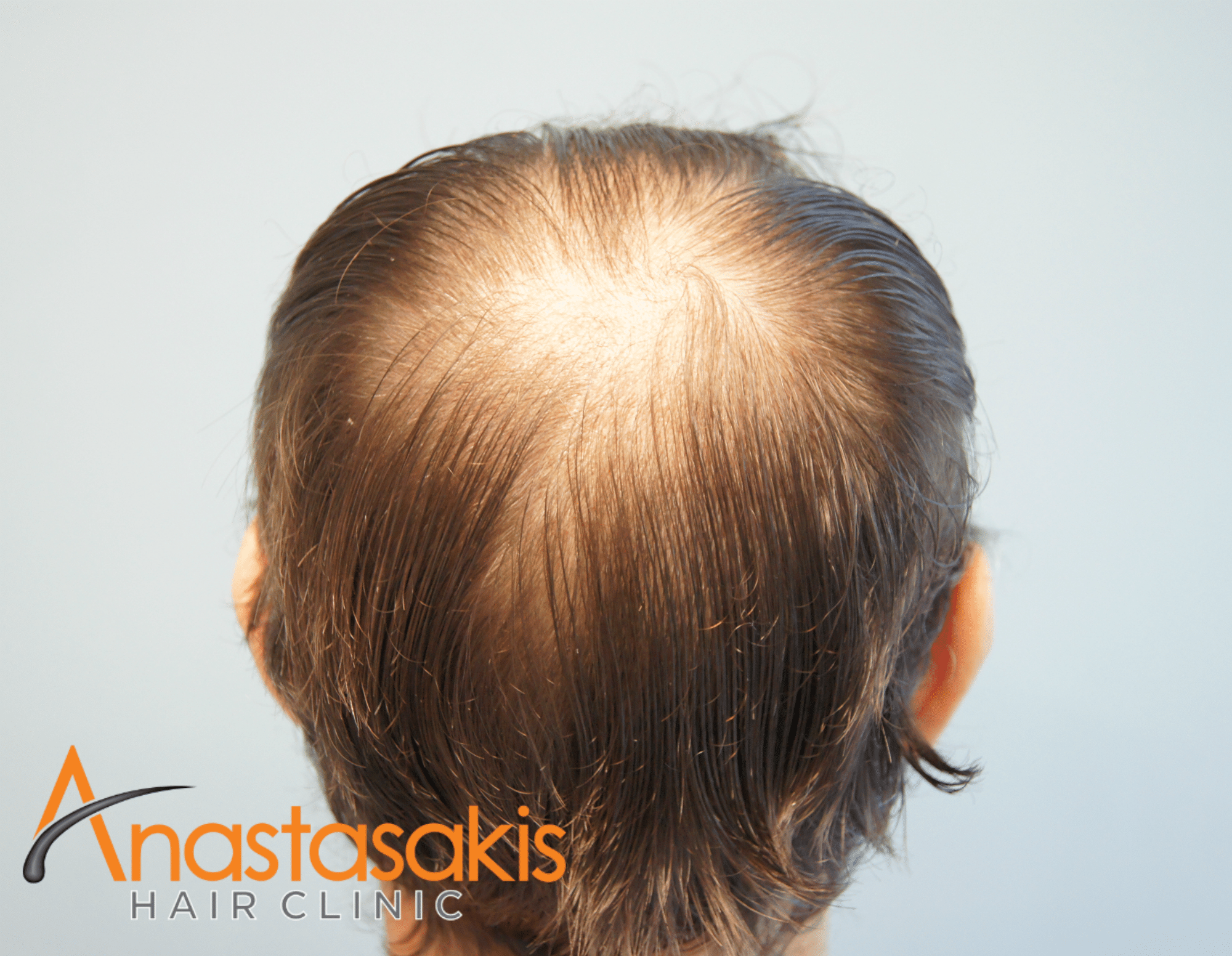 2530-FUS-result-anastasakis-hair-clinic-mar-fut