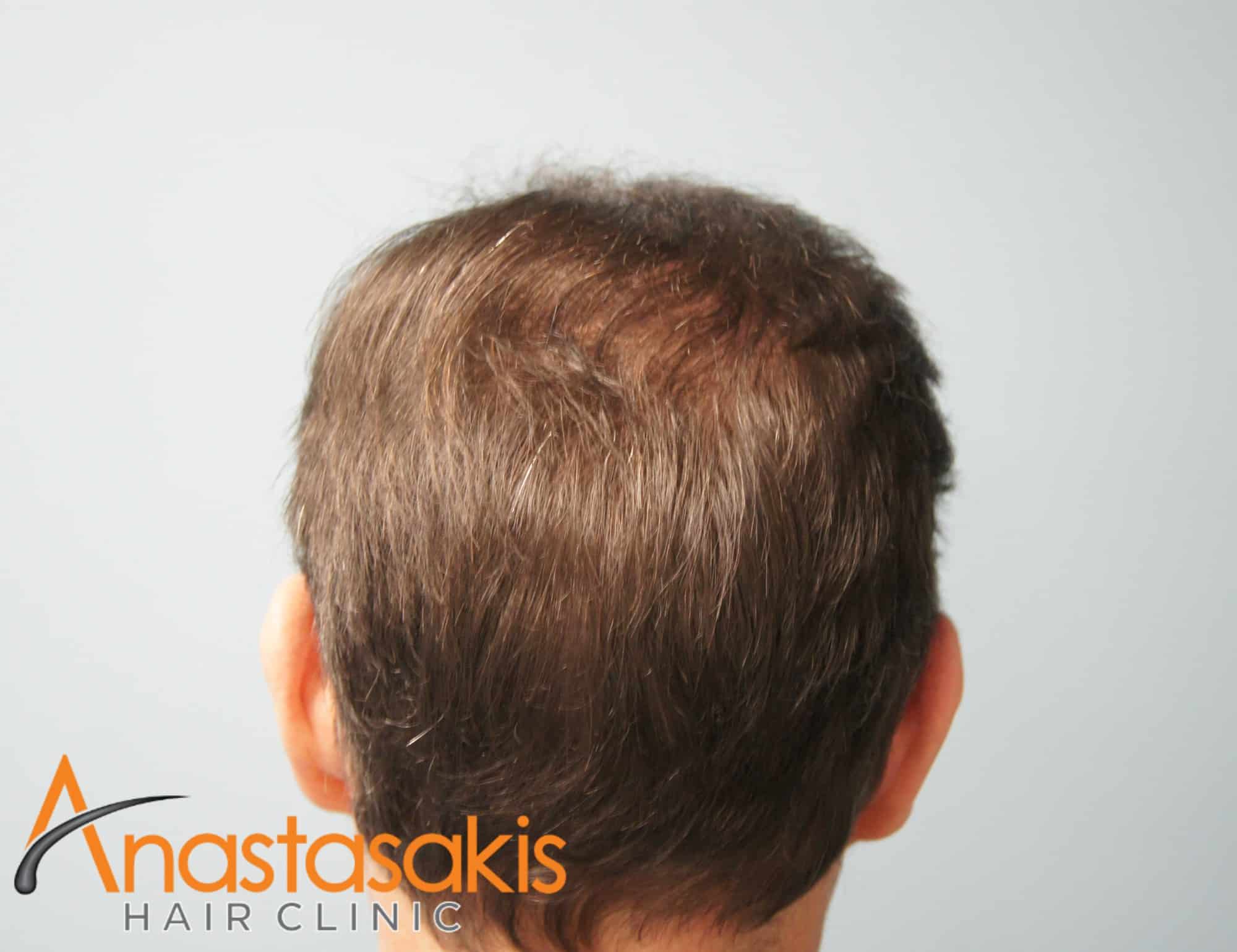 2530-FUS-result-anastasakis-hair-clinic-mar-fut