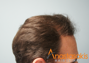 2530-FUS-result-anastasakis-hair-clinic-mar-fut