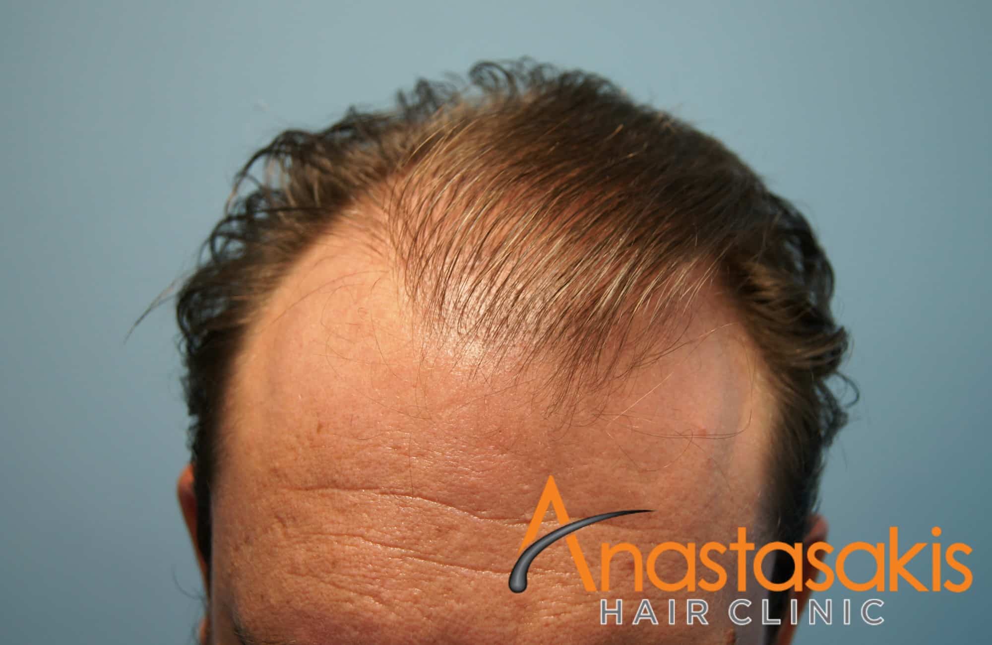 αποτέλεσμα ασθενούς στο hairline πριν την επέμβαση μαλλιών fue με 3000fus