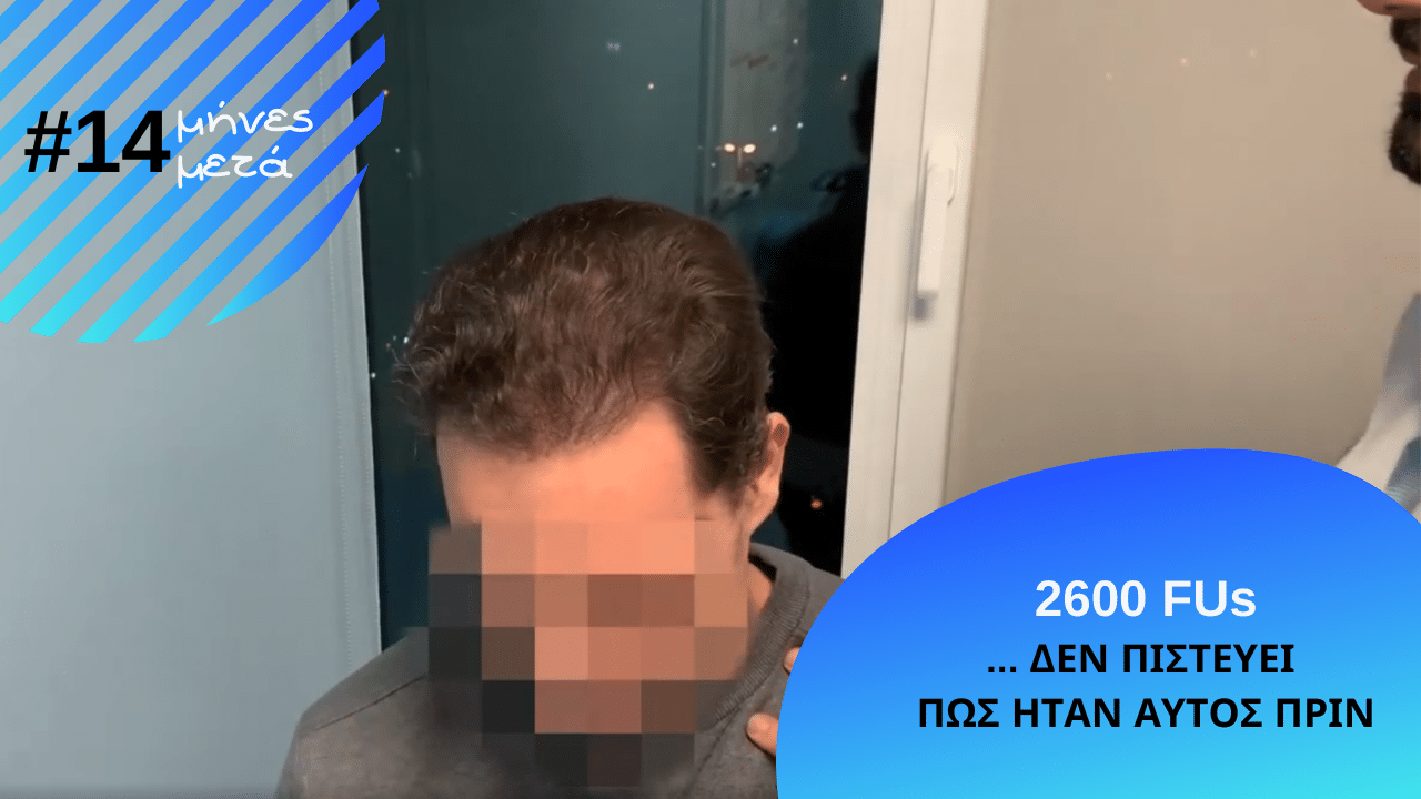 εντυπωσιακο αποτελεσμα σε video μετα απο 14 μηνες και 2600 τριχοθυλακια