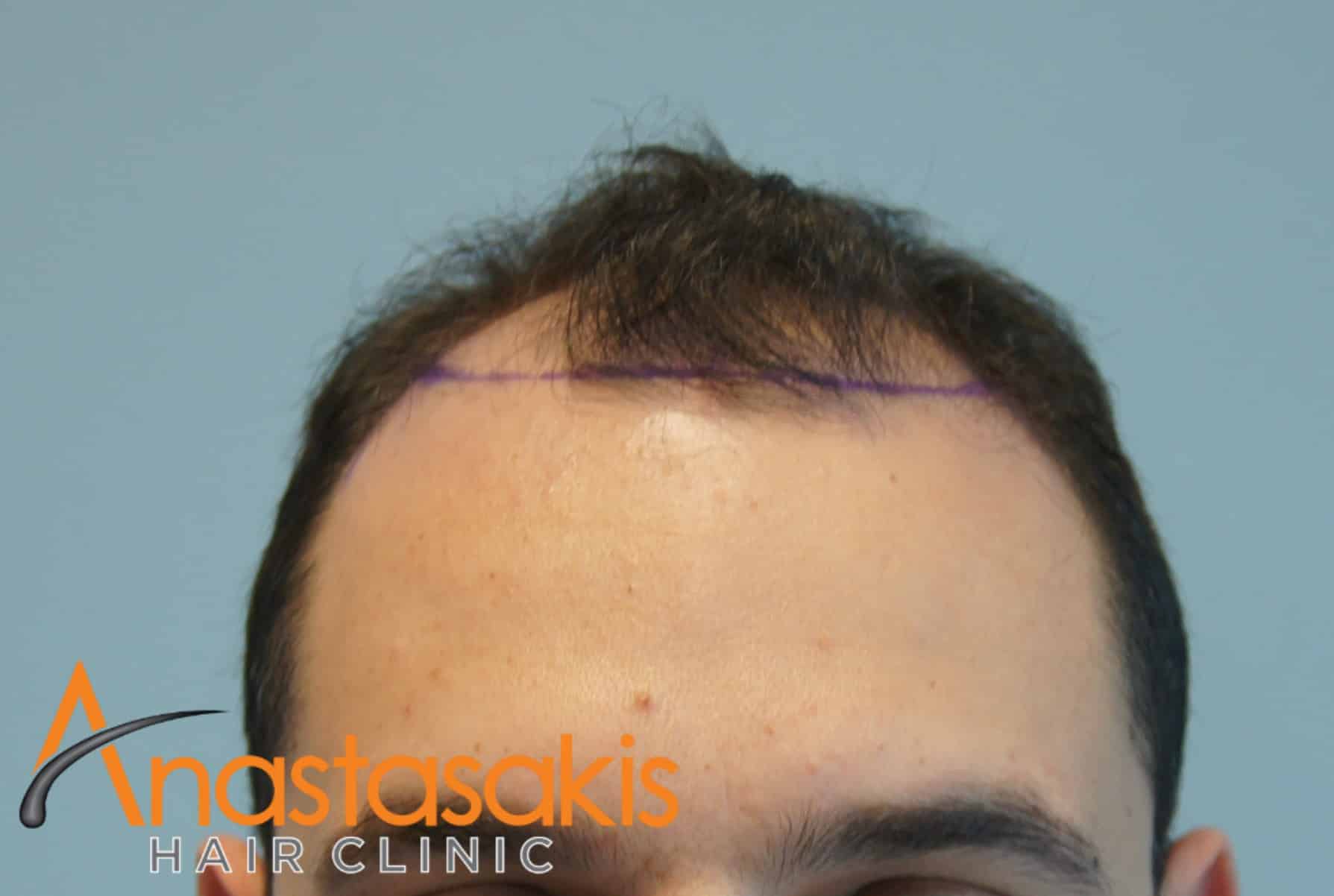 ασθενής πριν την εμφύτευση μαλλιών fue με 1600fus hairline