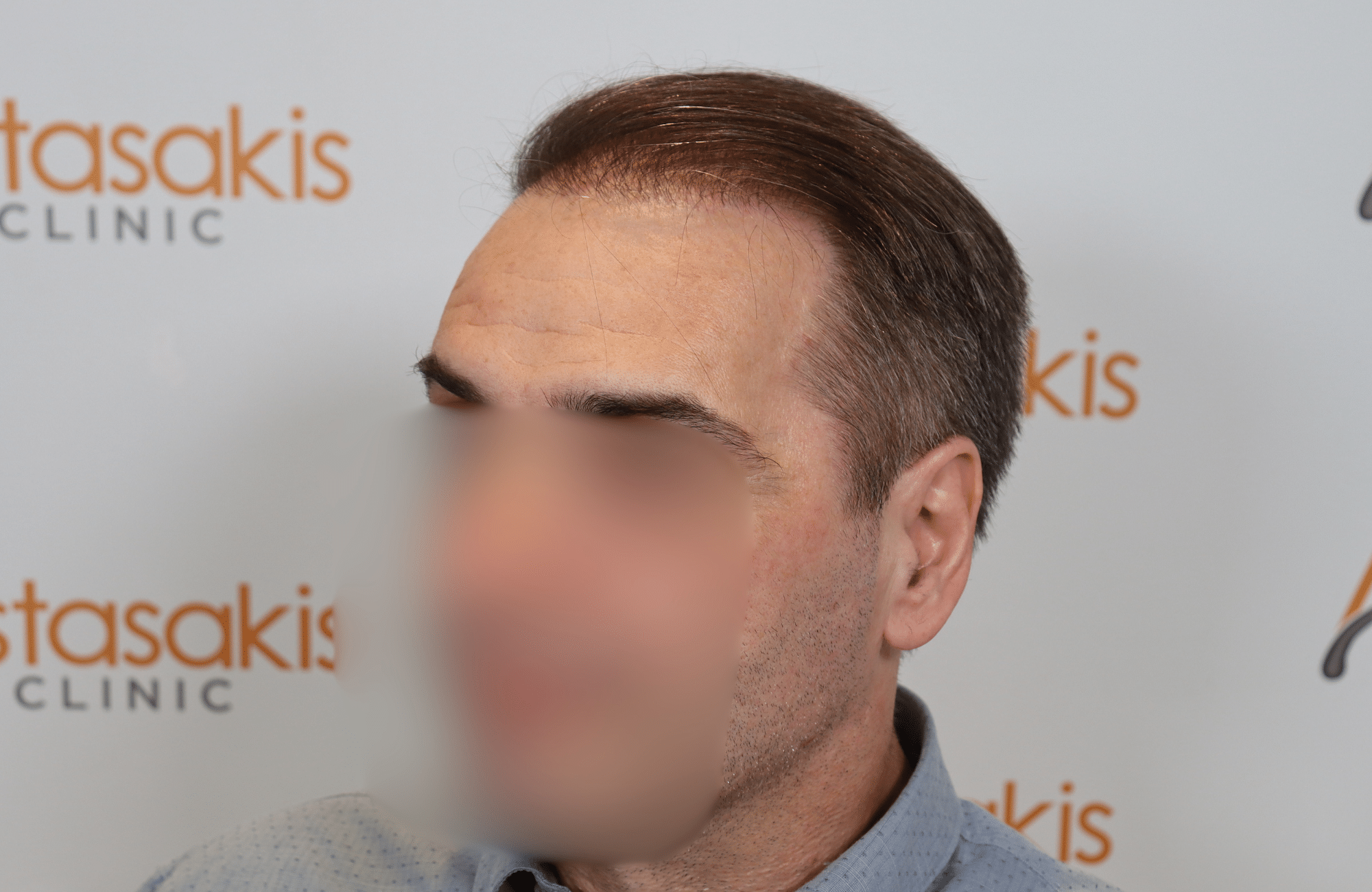 HAIR TRANSPLANT RESULT 2500 FUS (13)