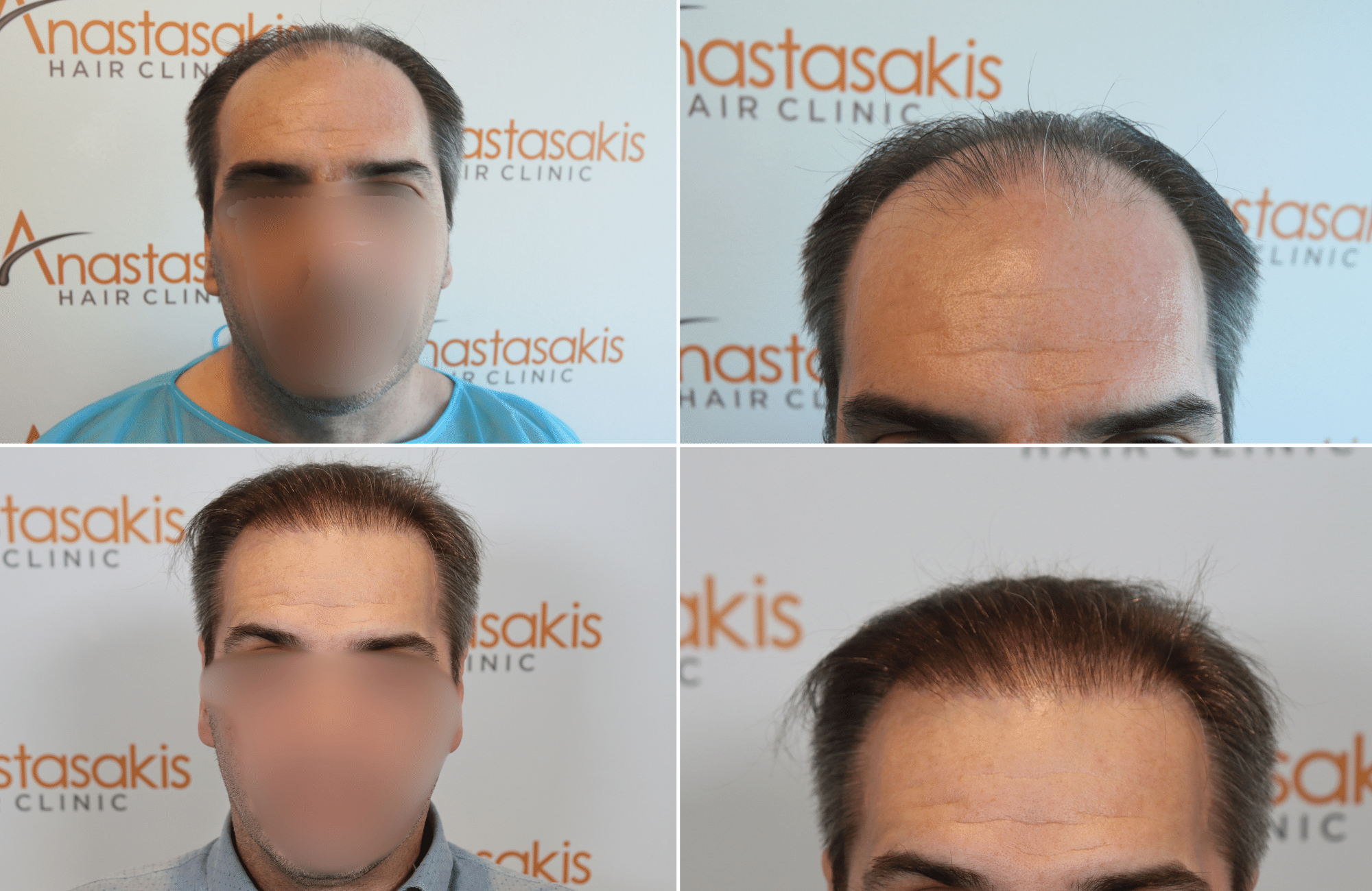 https://www.anastasakishairclinic.gr/portfolio/apotelesma-metamosxefsis-mallion-anastasakis-hair-clinic-200/