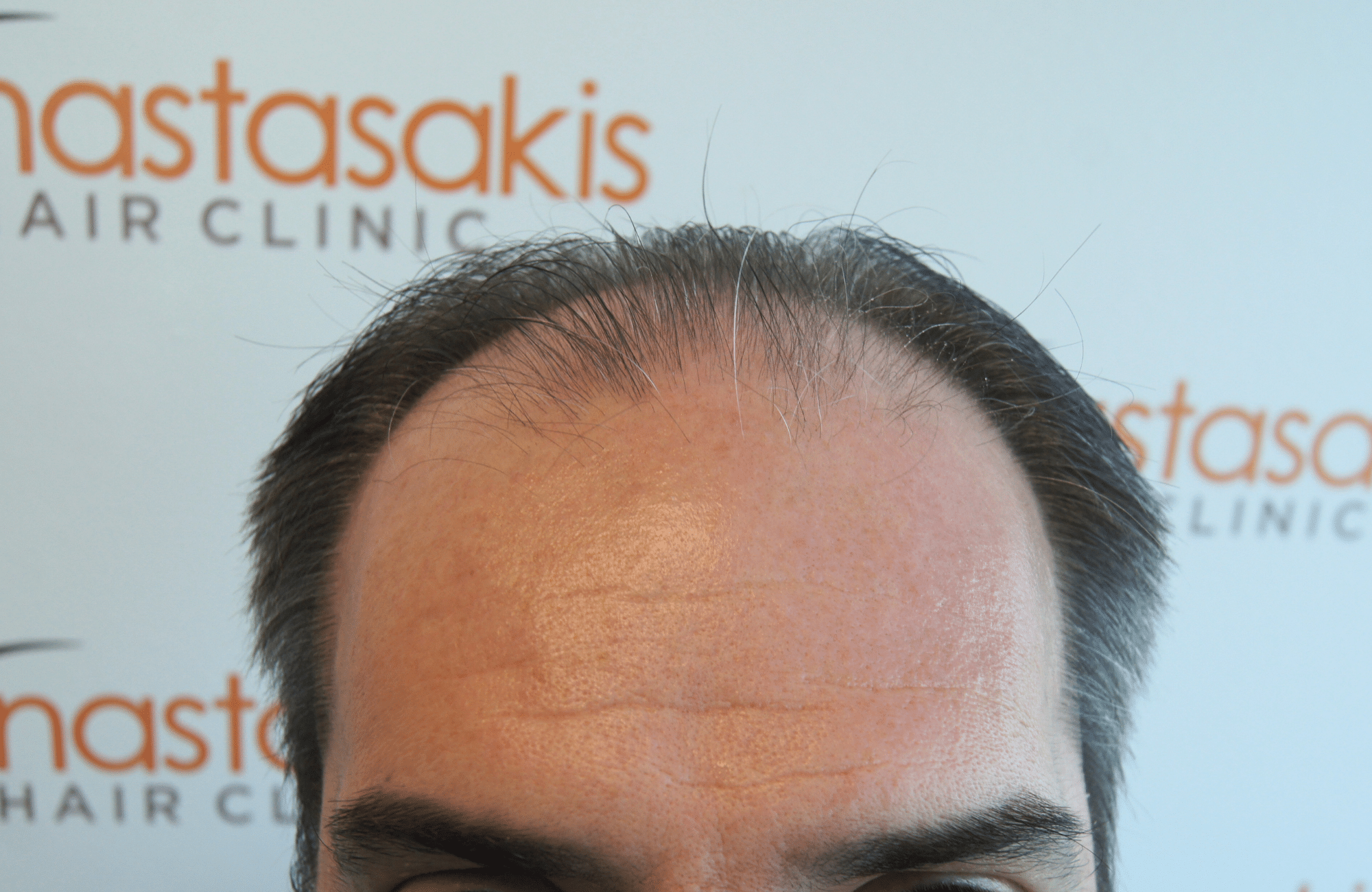 HAIR TRANSPLANT RESULT 2500 FUS (2)