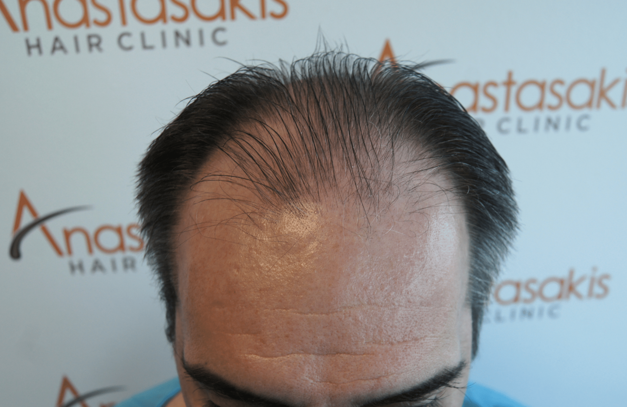 HAIR TRANSPLANT RESULT 2500 FUS (9)