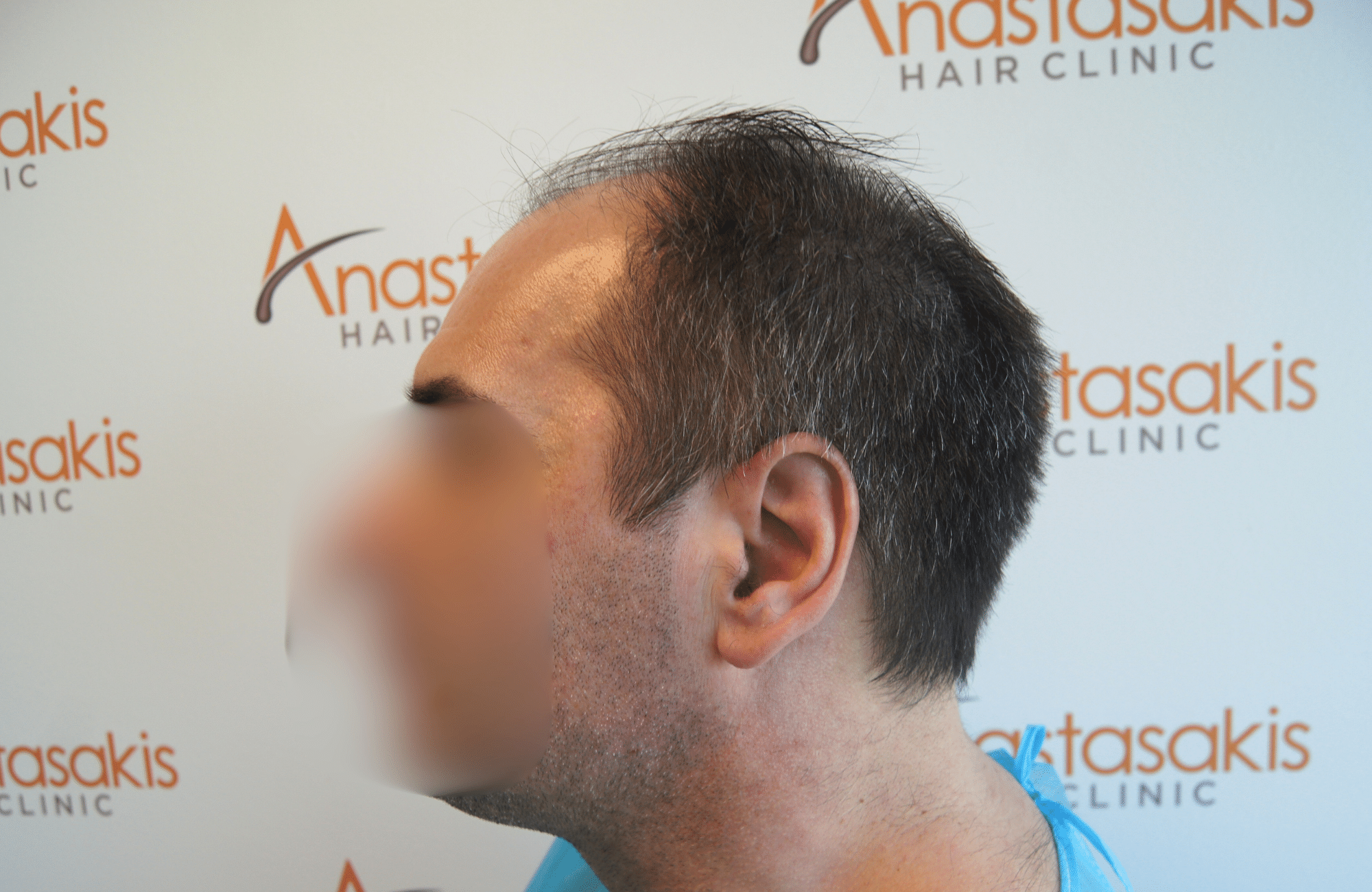 HAIR TRANSPLANT RESULT 2500 FUS (6)