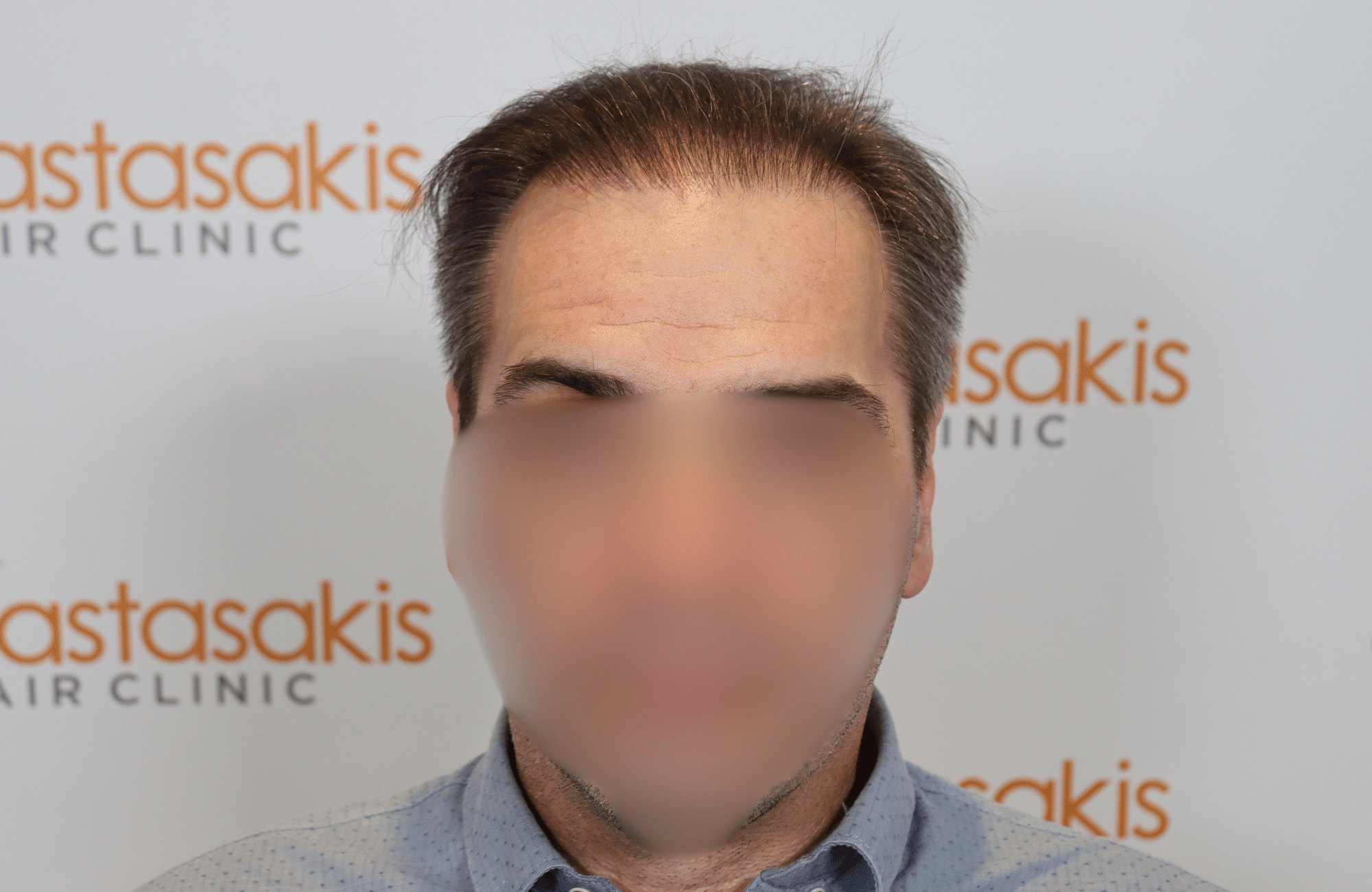 HAIR TRANSPLANT RESULT 2500 FUS (8)