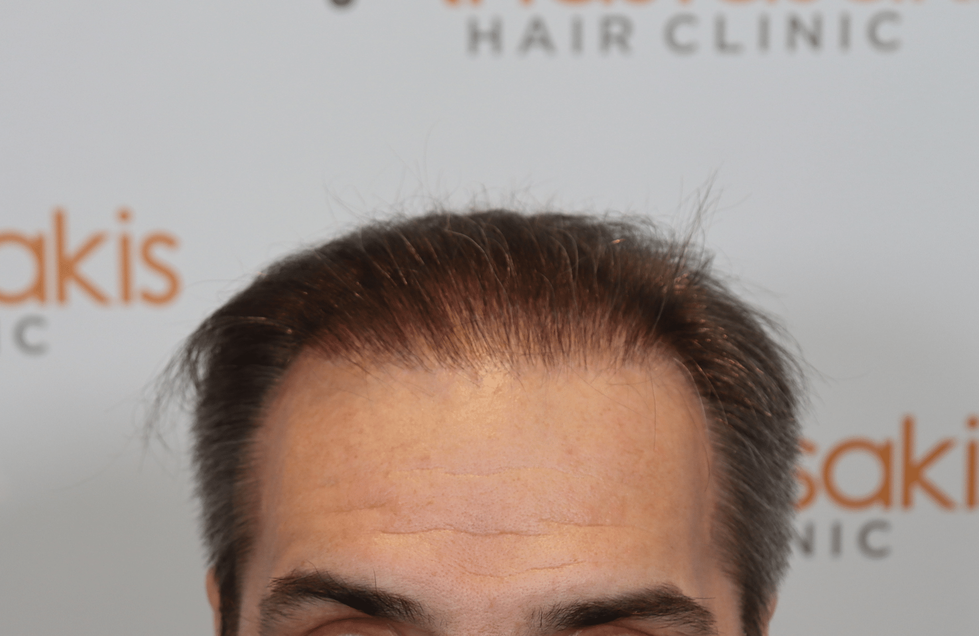 HAIR TRANSPLANT RESULT 2500 FUS (9)