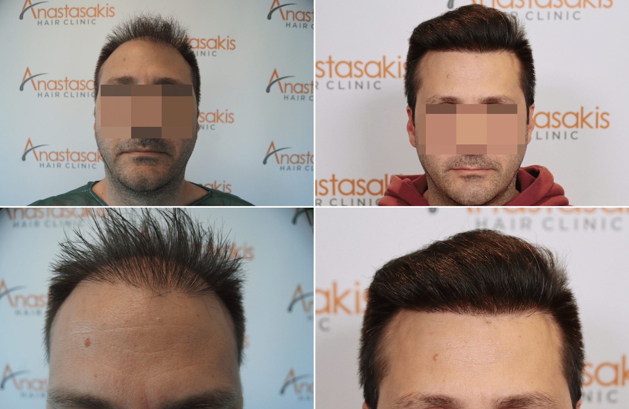 https://www.anastasakishairclinic.gr/portfolio/anastasakishair-clinic-result-3000-fus-2/