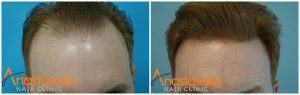 επιτυχής μεταμόσχευση μαλλιών πριν-μετά αναστασάκης hair clinic