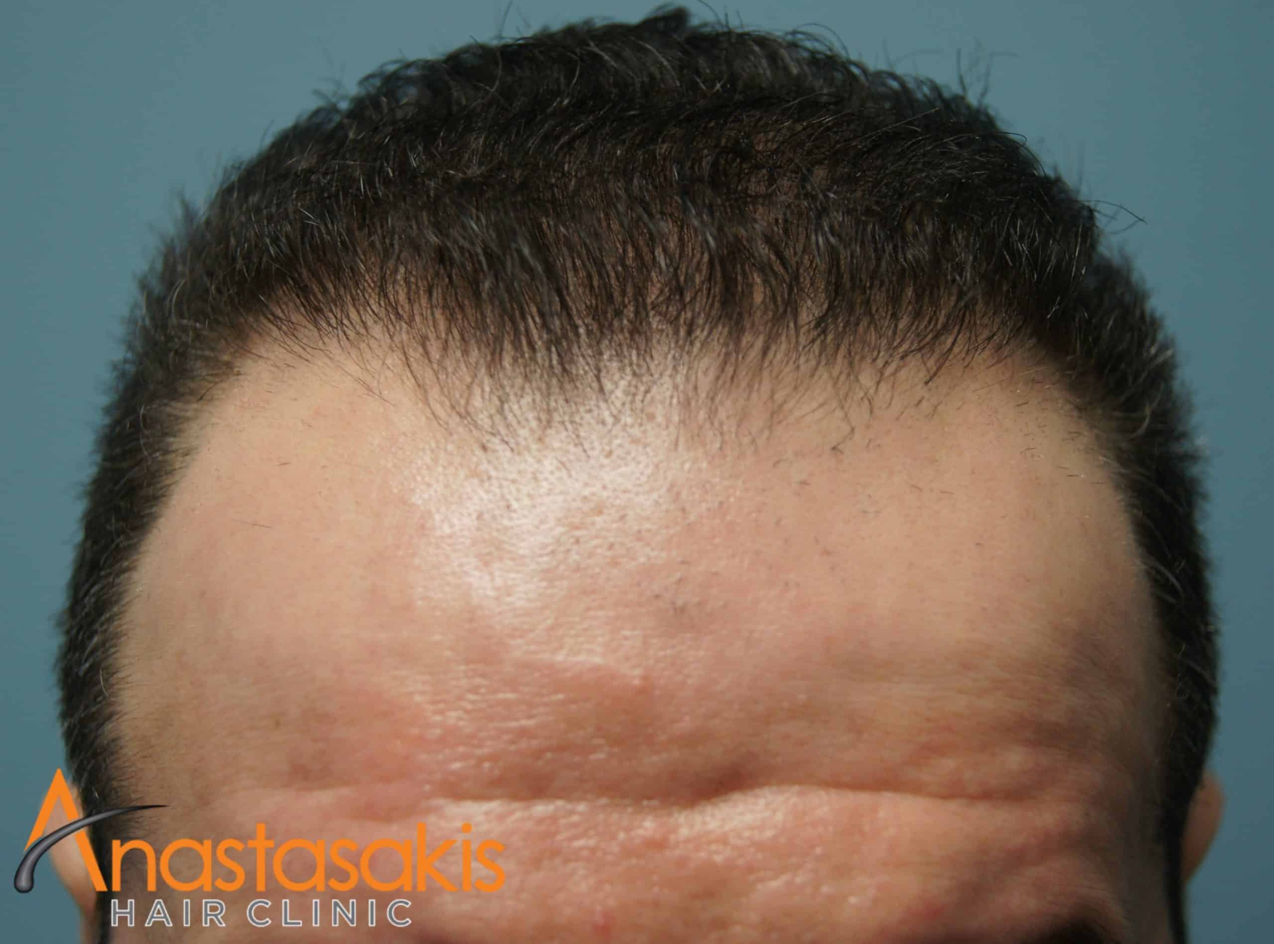 ασθενής μετά την εμφύτευση μαλλιών fut με 2000fus hairline