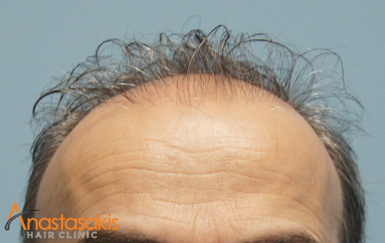 hairline ασθενους πριν τη μεταμοσχευση μαλλιων με 2500 fus