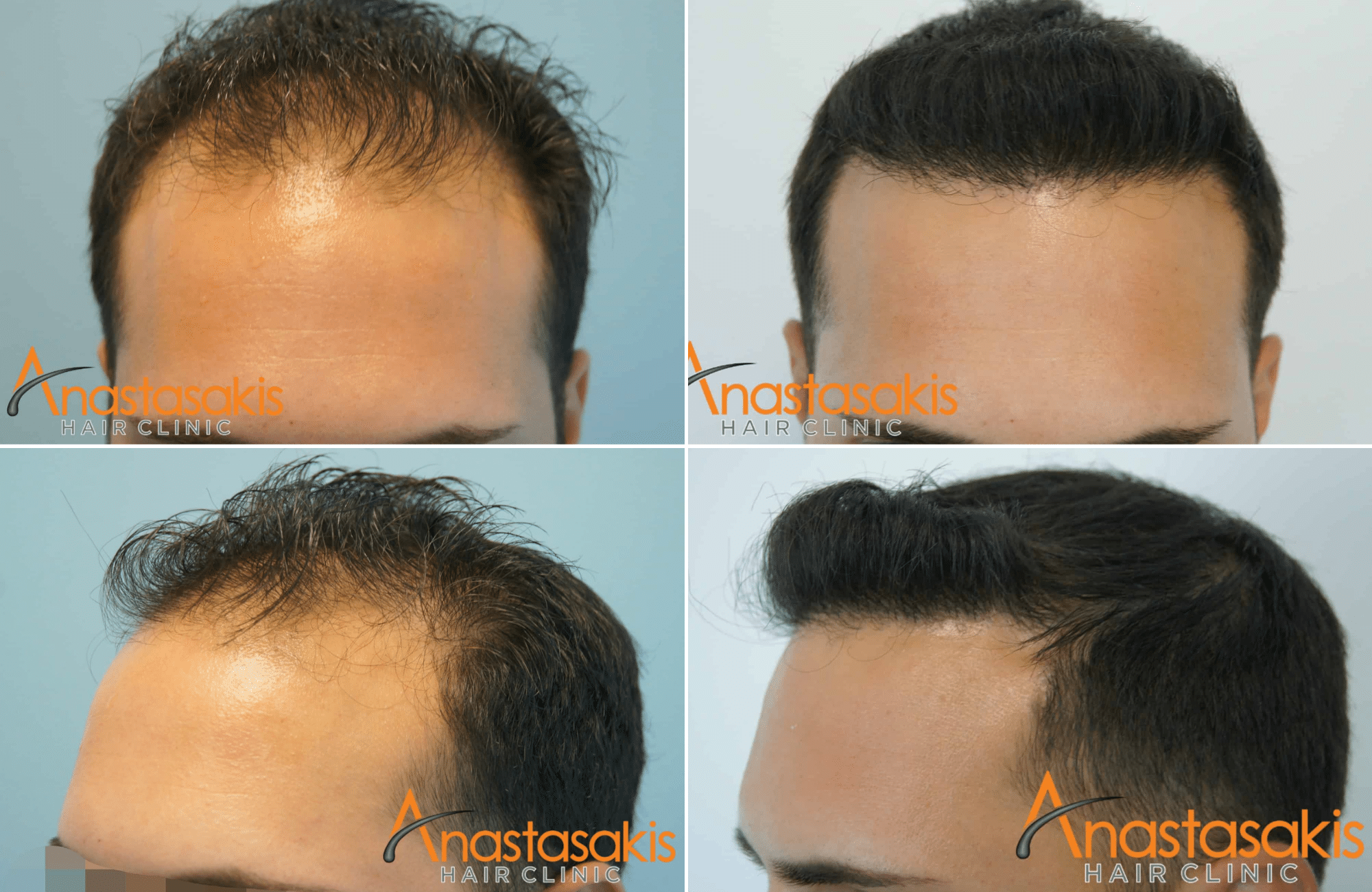 https://www.anastasakishairclinic.gr/portfolio/1500-fus-fue-anastasakishairclinic-result/