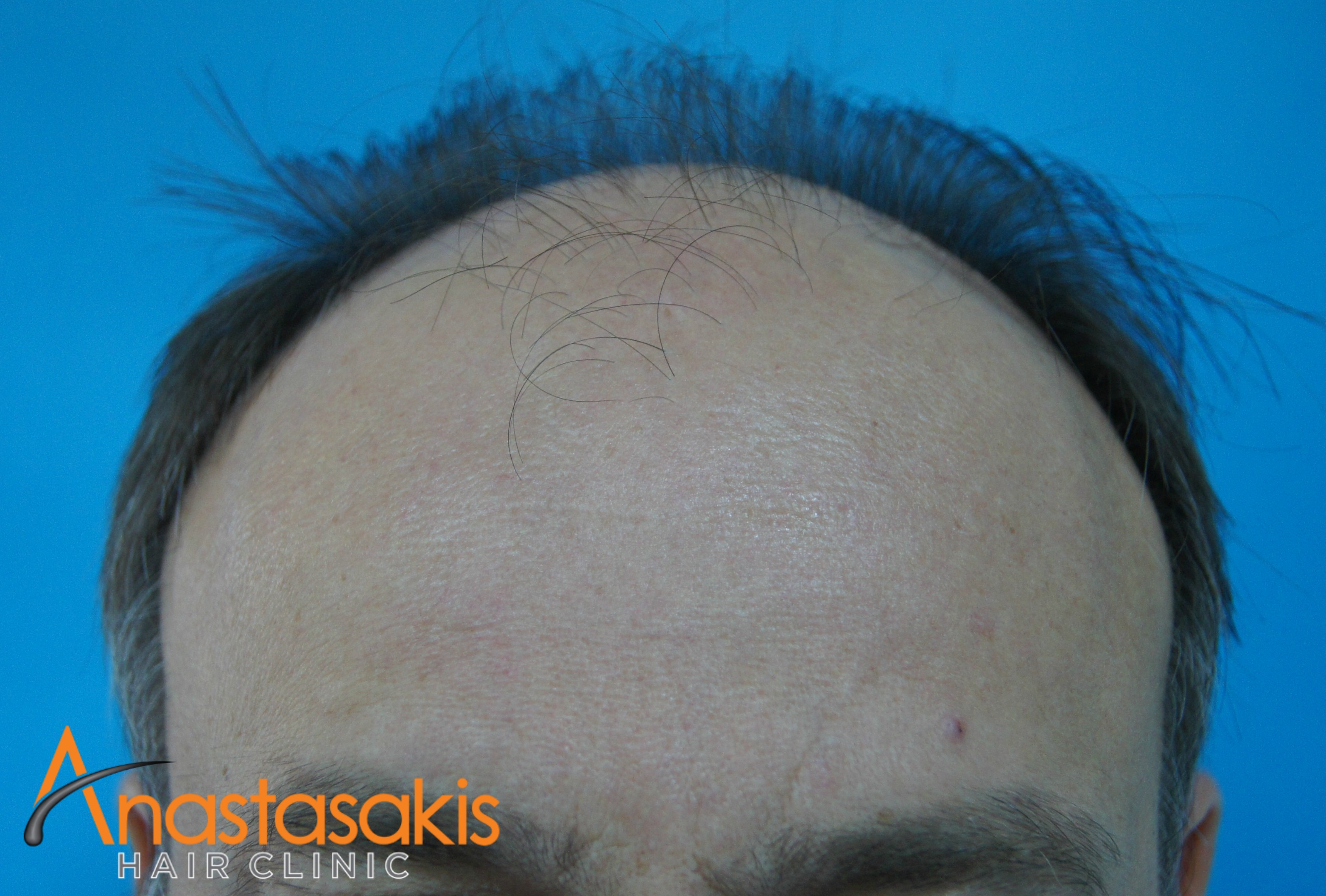 ασθενής πριν την μεταμόσχευση μαλλιών fut με 3500fus hairline